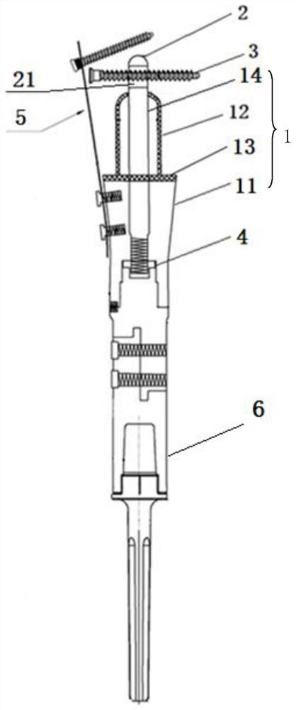 Intramedullary pressurization fixing device for adjacent articular bone defect prosthesis reconstruction