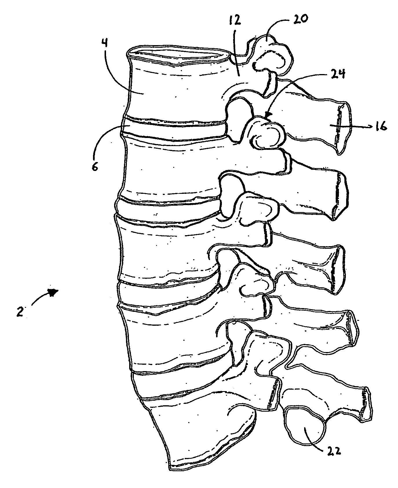 Flanged interbody fusion device with hinge