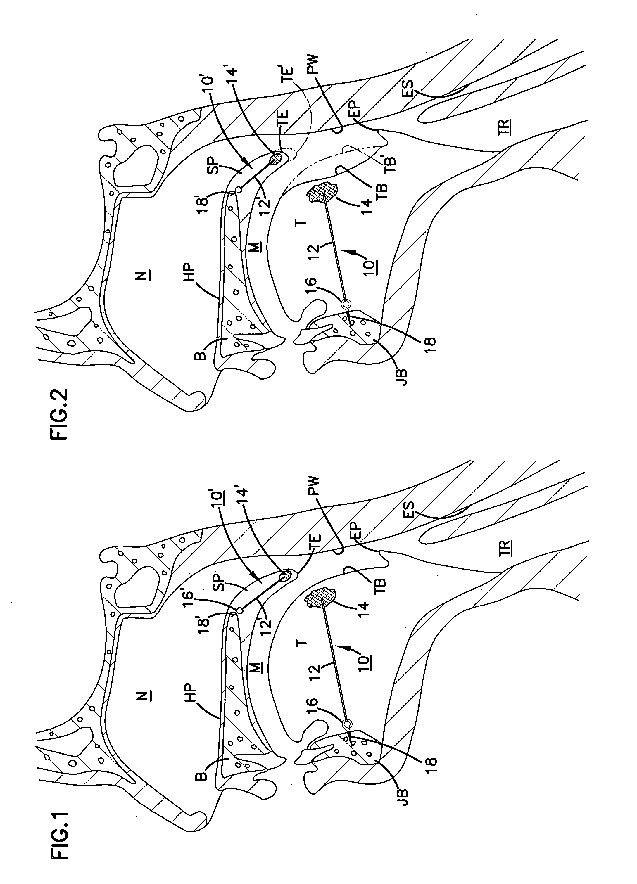 Airway implant