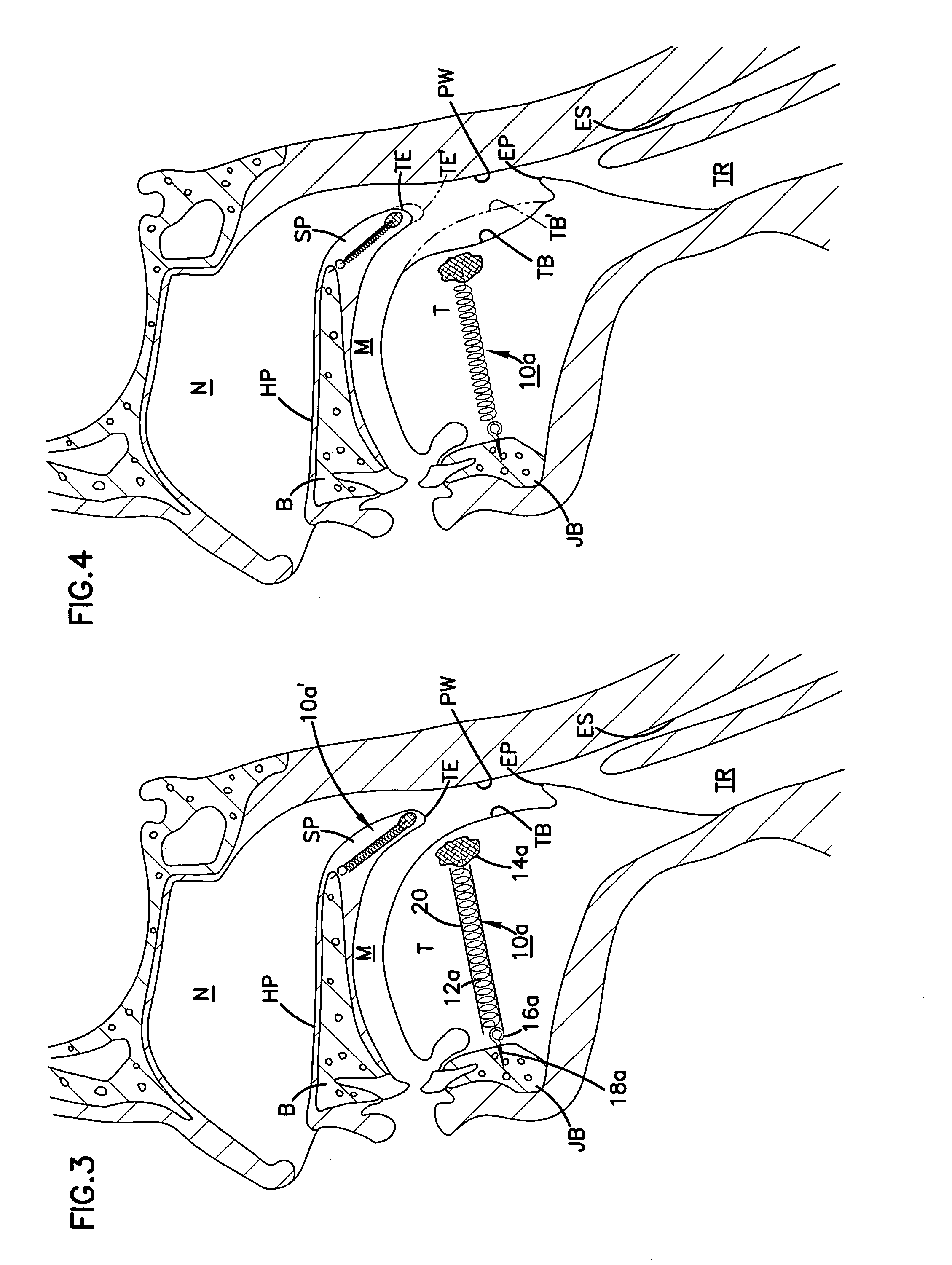 Airway implant