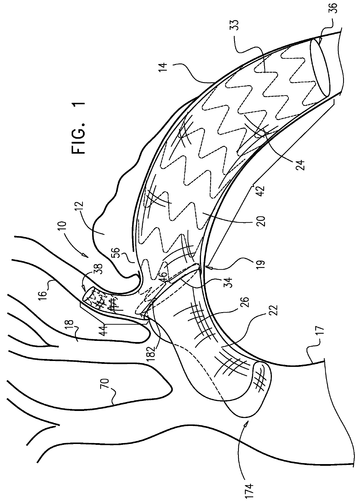 Multi-component stent-graft system for aortic dissections