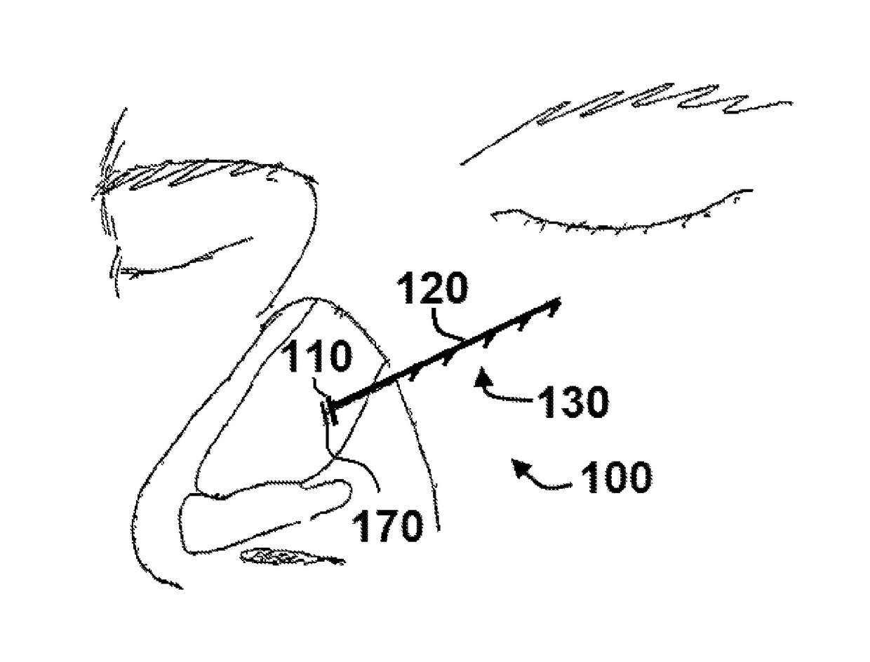 Apparatus and methods for correcting nasal valve collapse