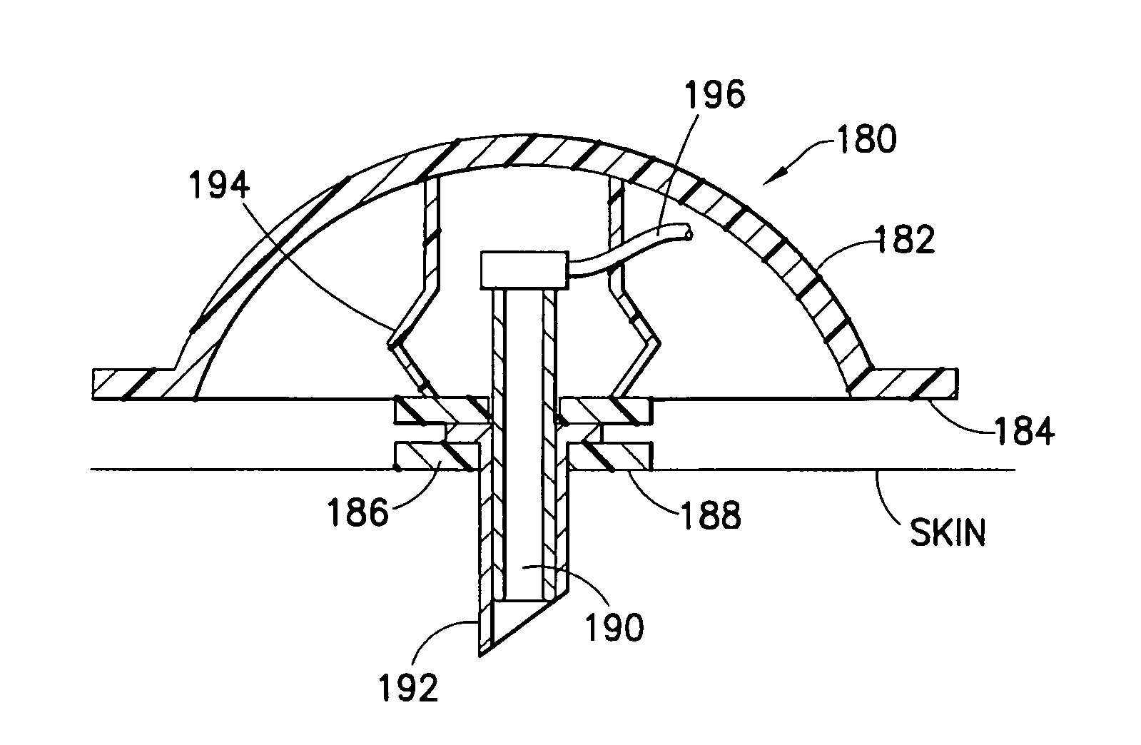 Infusion set and/or patch pump having at least one of an in-dwelling rigid catheter with flexible features and/or a flexible catheter attachment