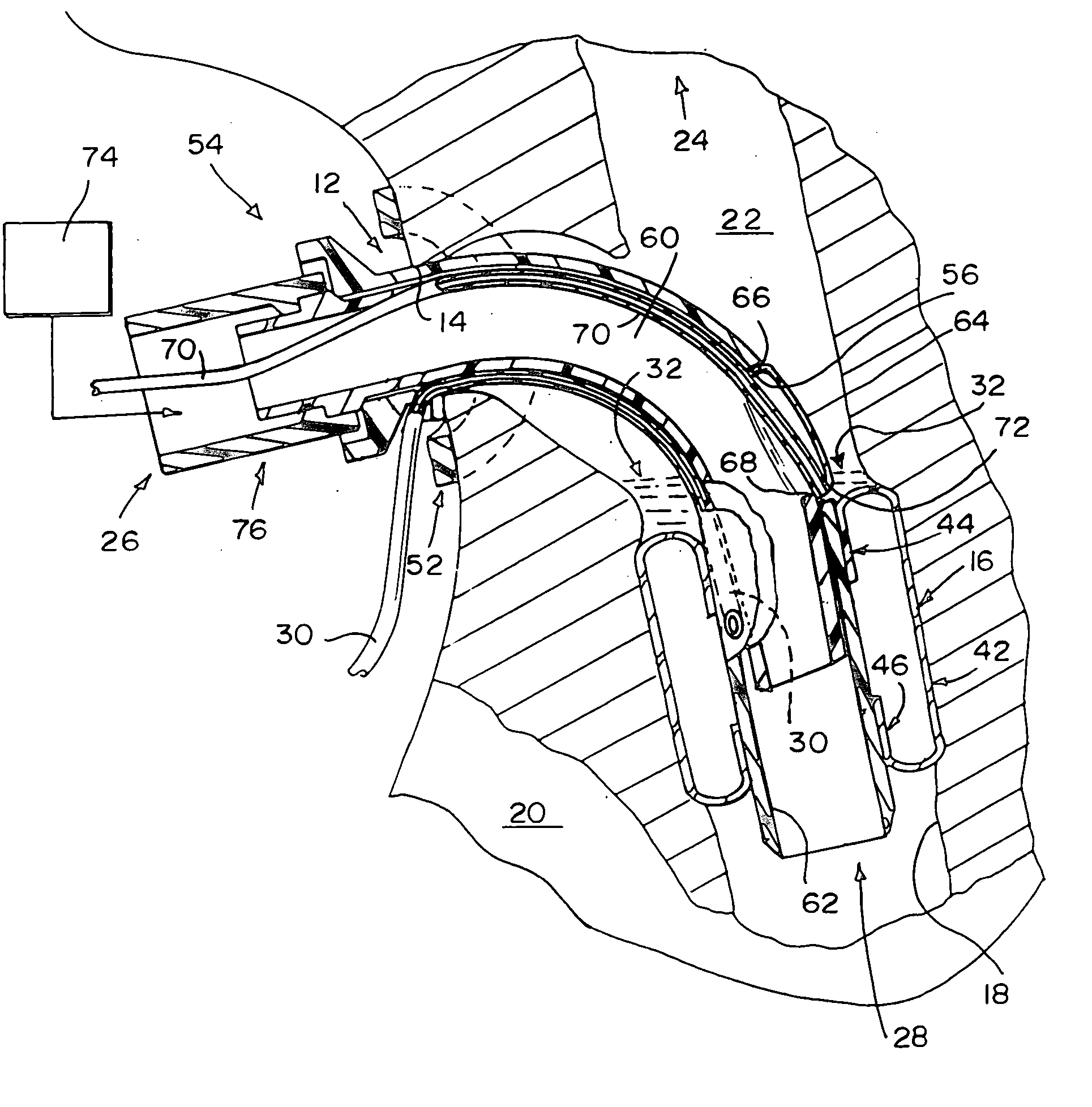 Valved fenestrated tracheotomy tube having outer and inner cannulae