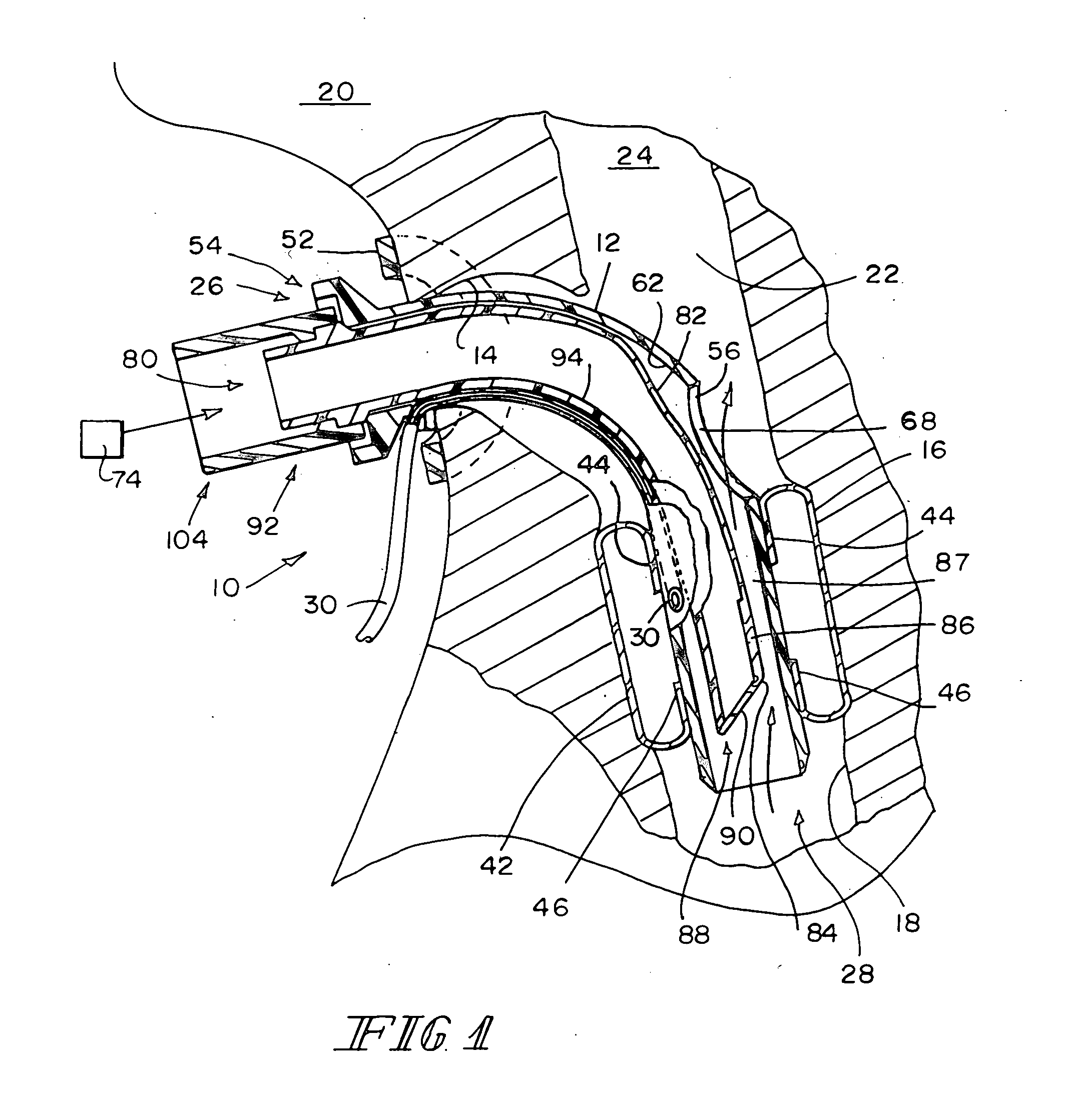 Valved fenestrated tracheotomy tube having outer and inner cannulae