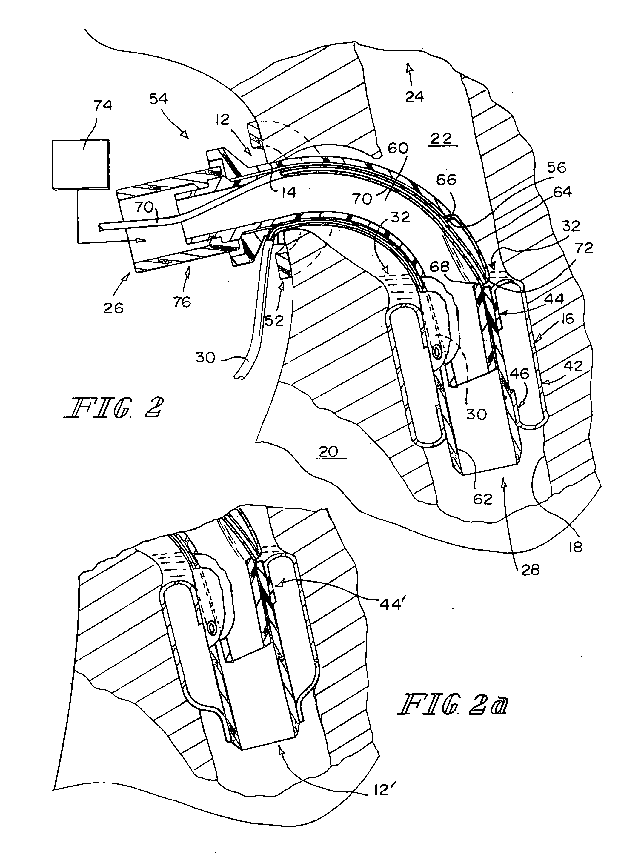 Valved fenestrated tracheotomy tube having outer and inner cannulae