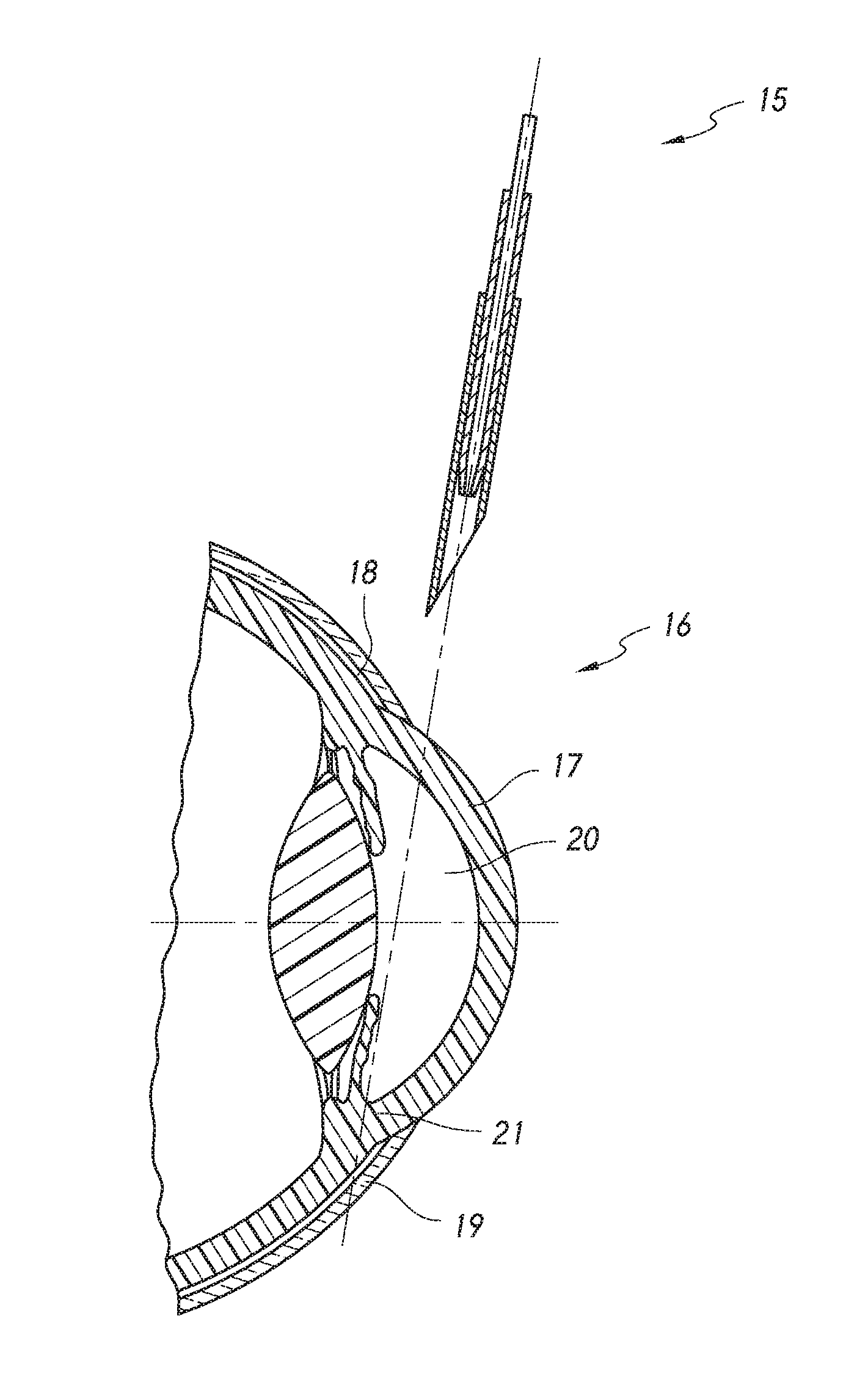 Intraocular shunt placement in the suprachoroidal space