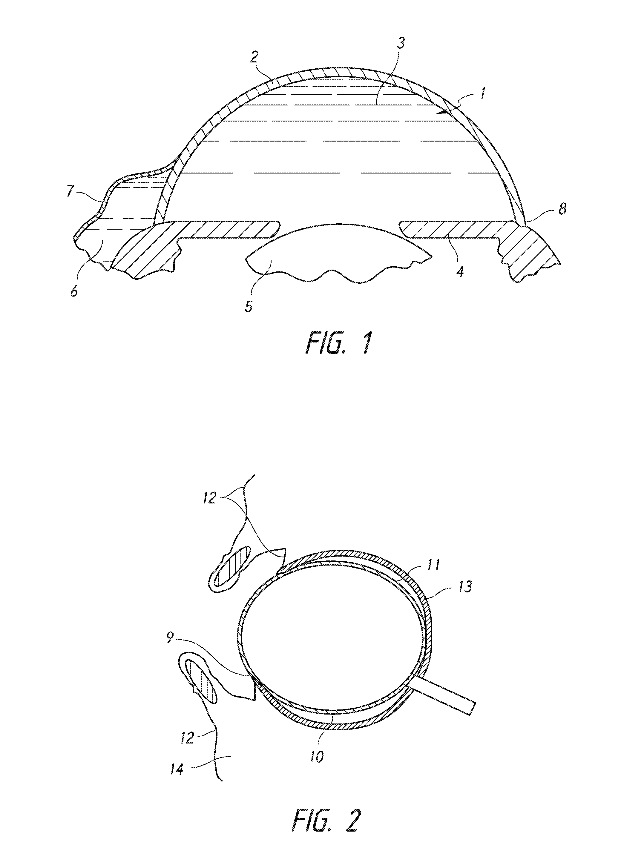 Intraocular shunt placement in the suprachoroidal space