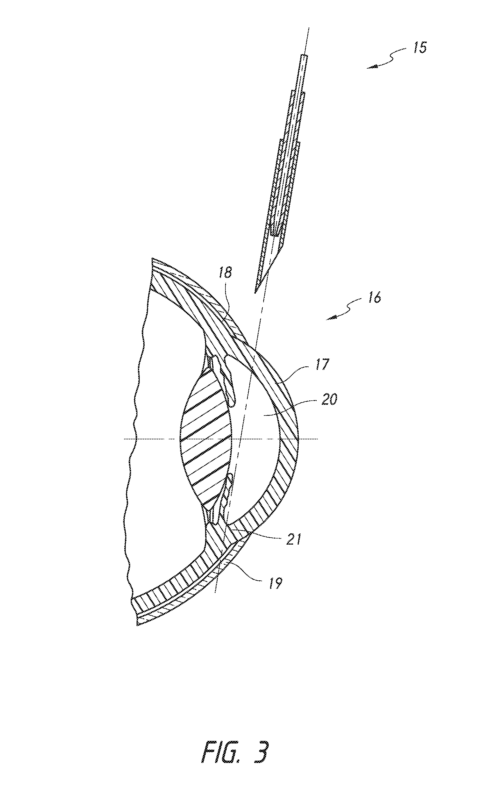 Intraocular shunt placement in the suprachoroidal space