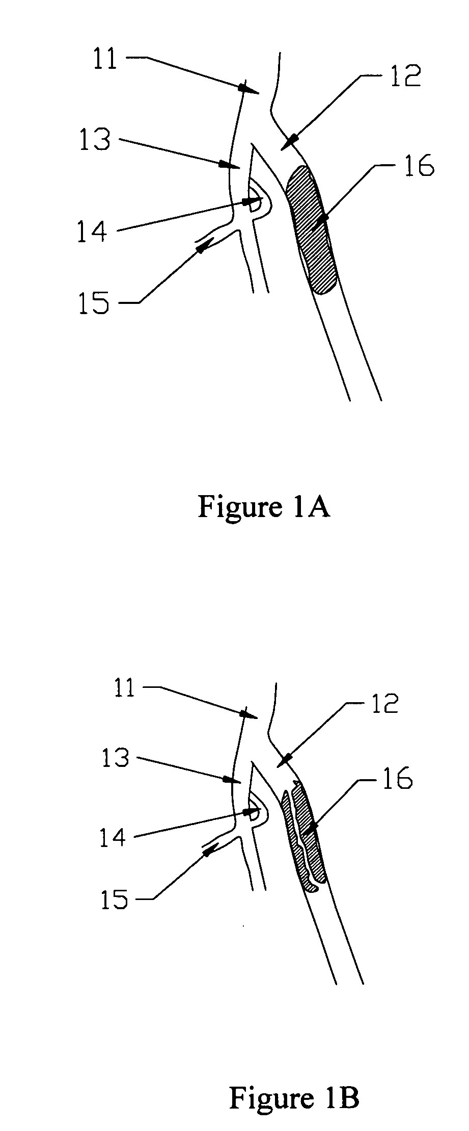 Catheter systems and methods for their use in the treatment of calcified vascular occlusions