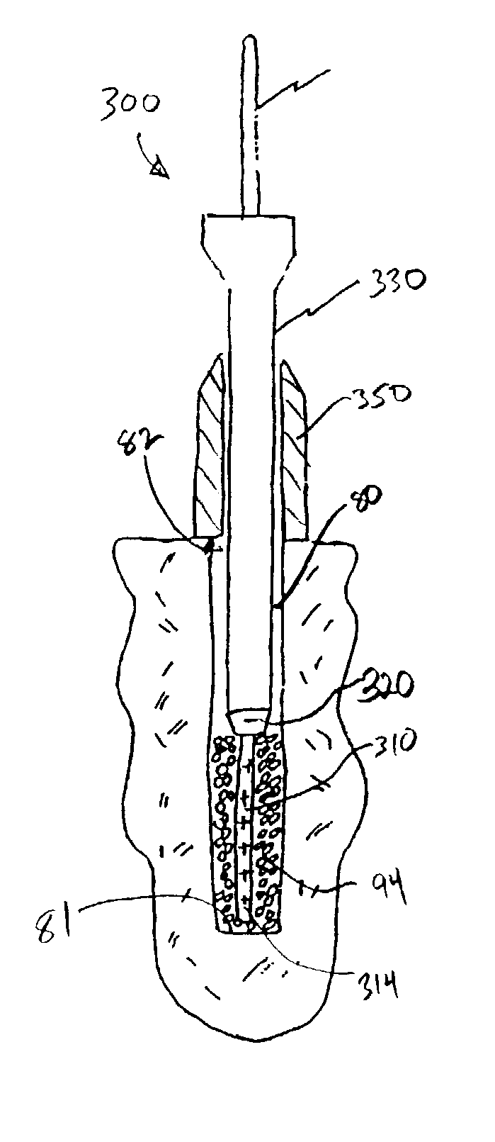 Apparatus and method for electrically induced thrombosis