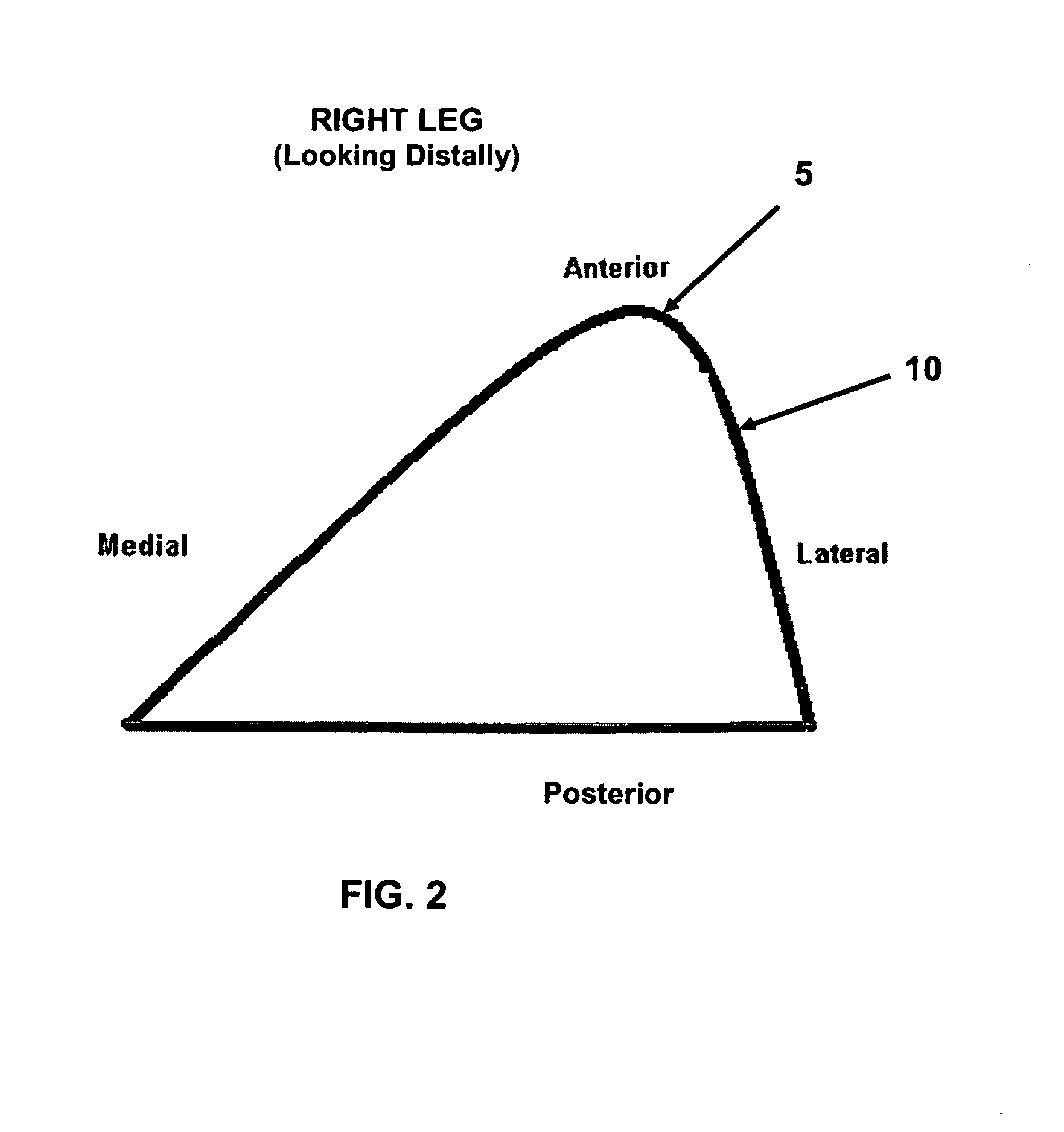 Method and apparatus for performing multidirectional tibial tubercle transfers