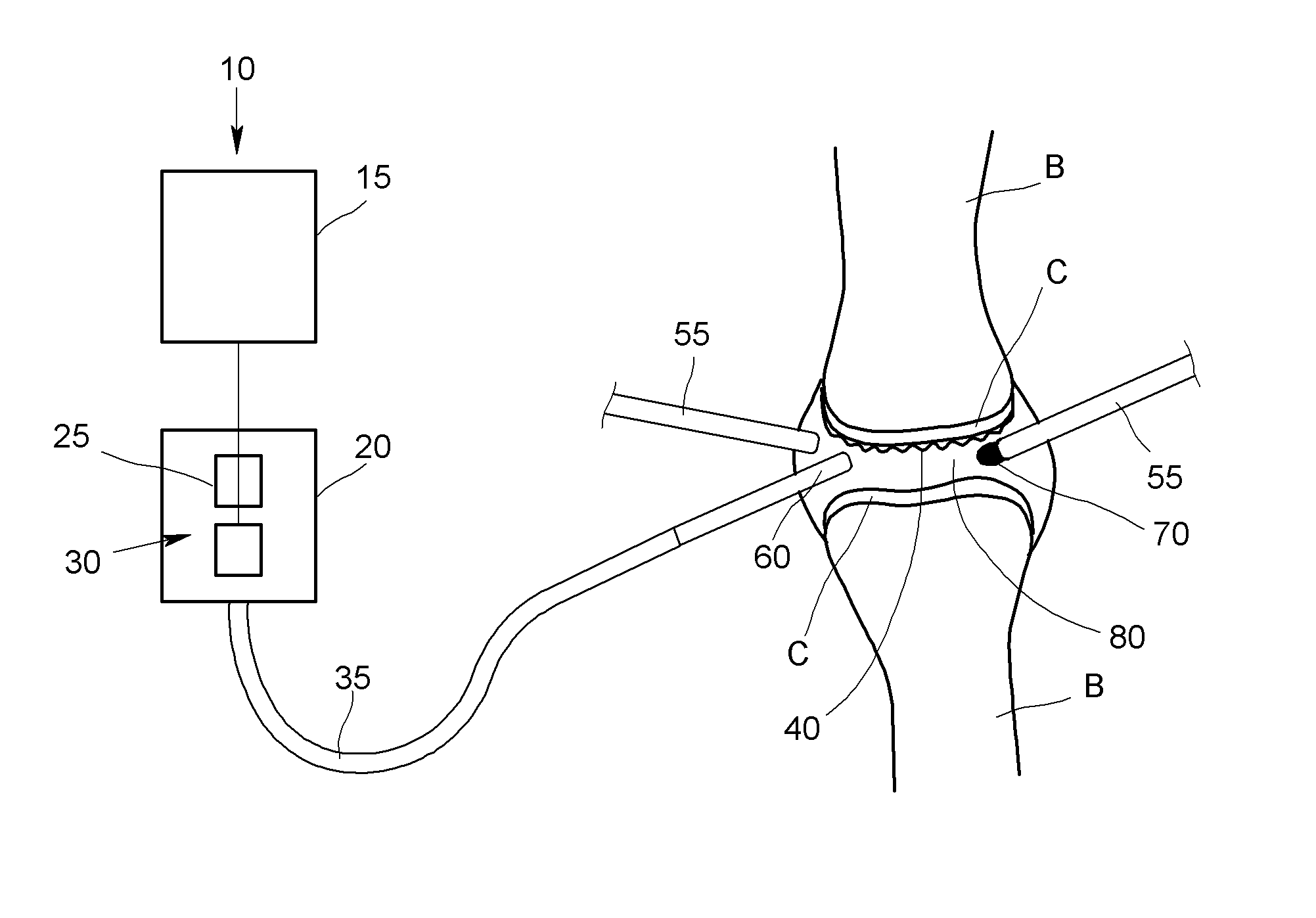 Method for the ablation of cartilage tissue in a knee joint using indocyanine