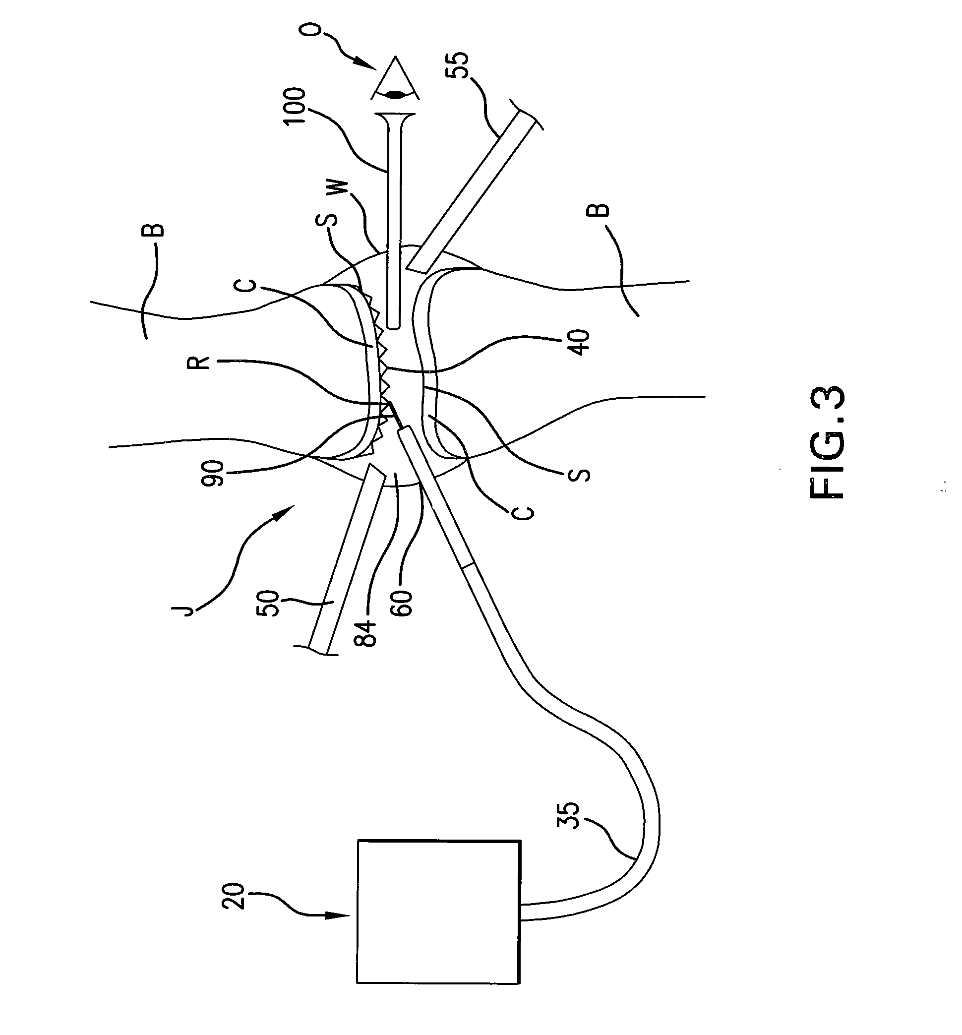 Method for the ablation of cartilage tissue in a knee joint using indocyanine