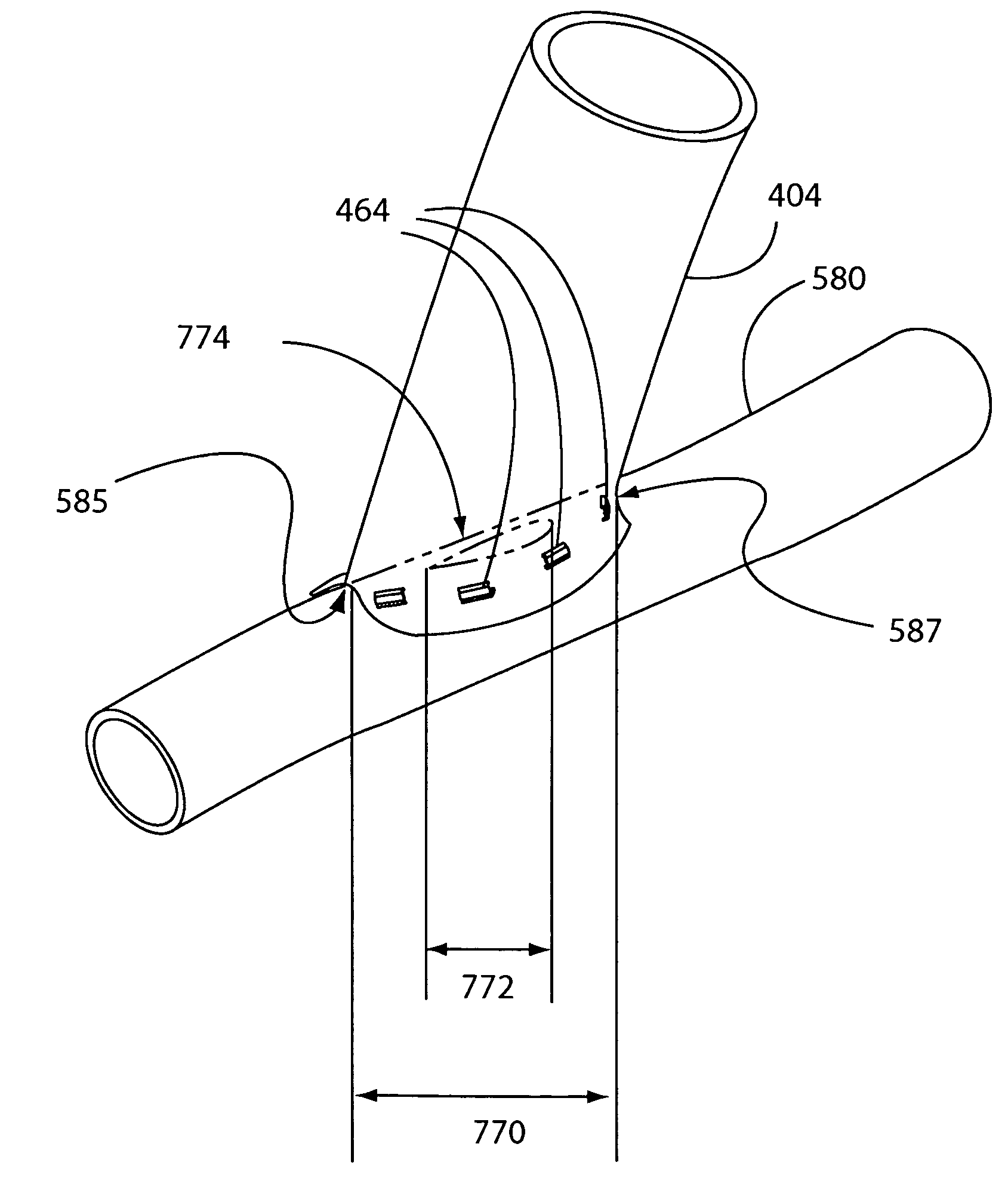 Surgical apparatus and method for anastomosis