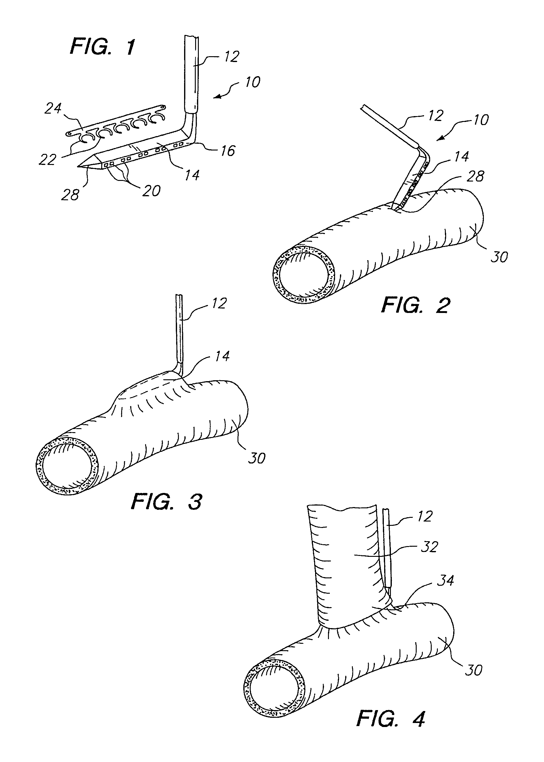 Surgical apparatus and method for anastomosis