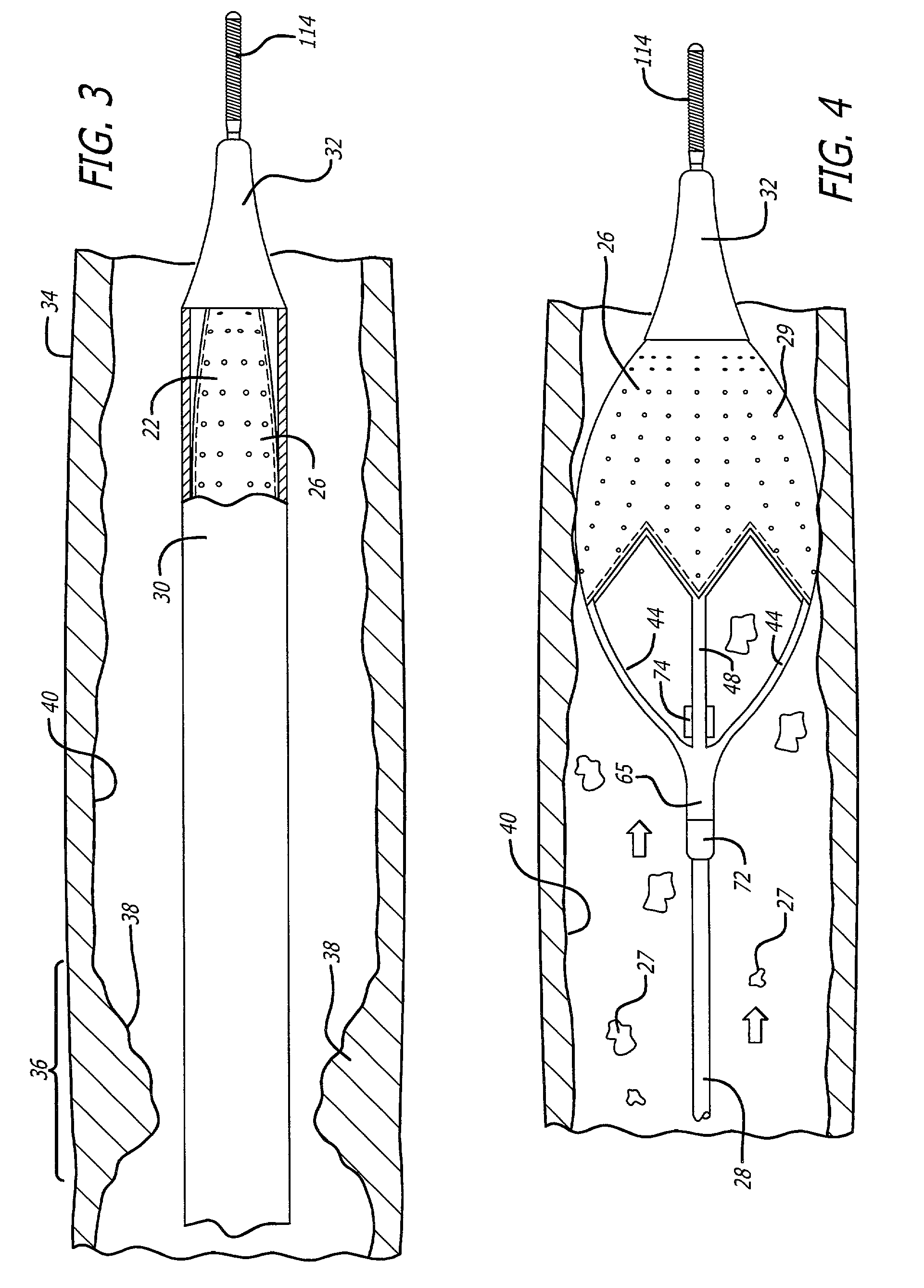 Expandable cages for embolic filtering devices