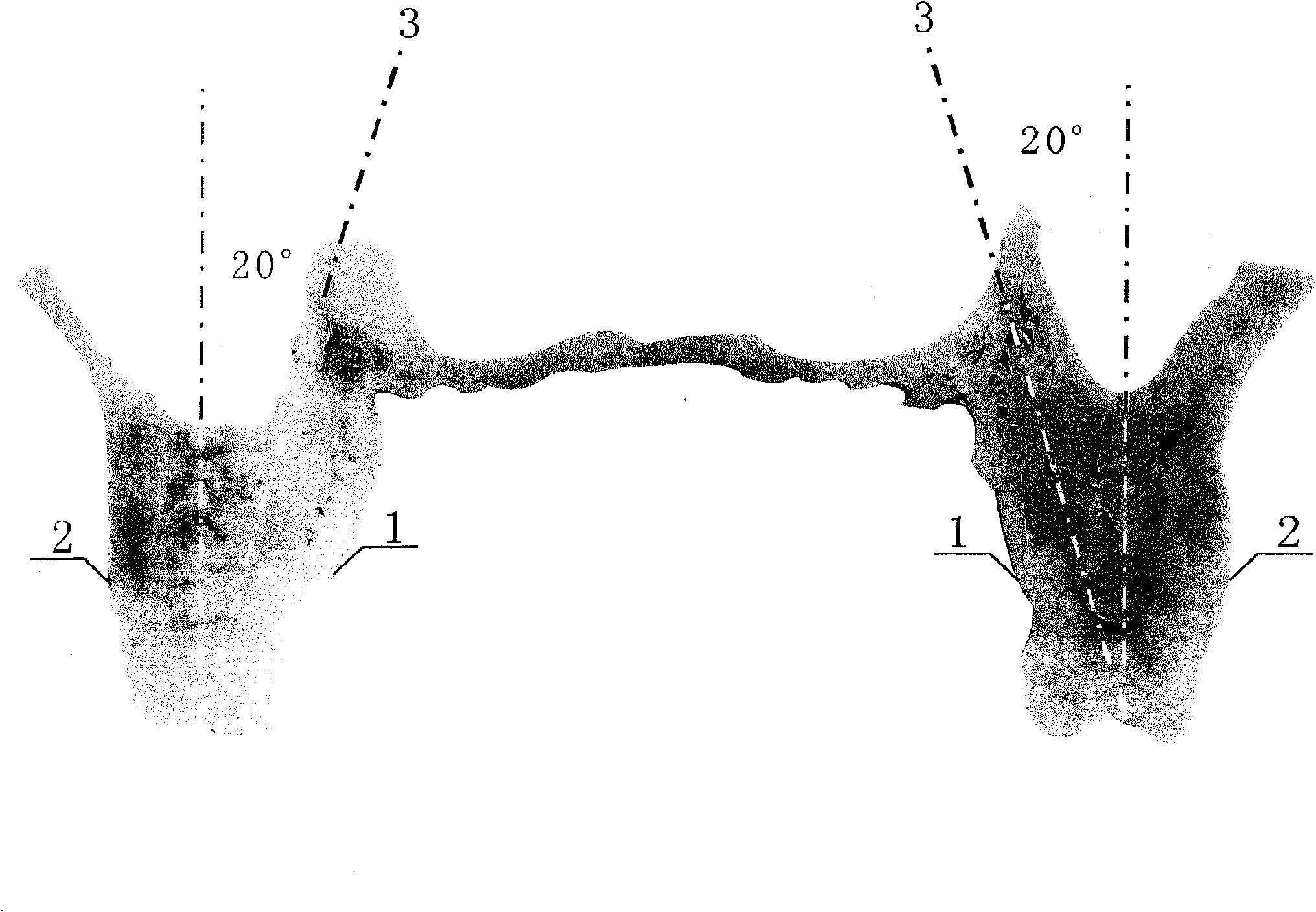 Implant method of maxillary molar without bone grafting and sinus floor elevating and dental implant