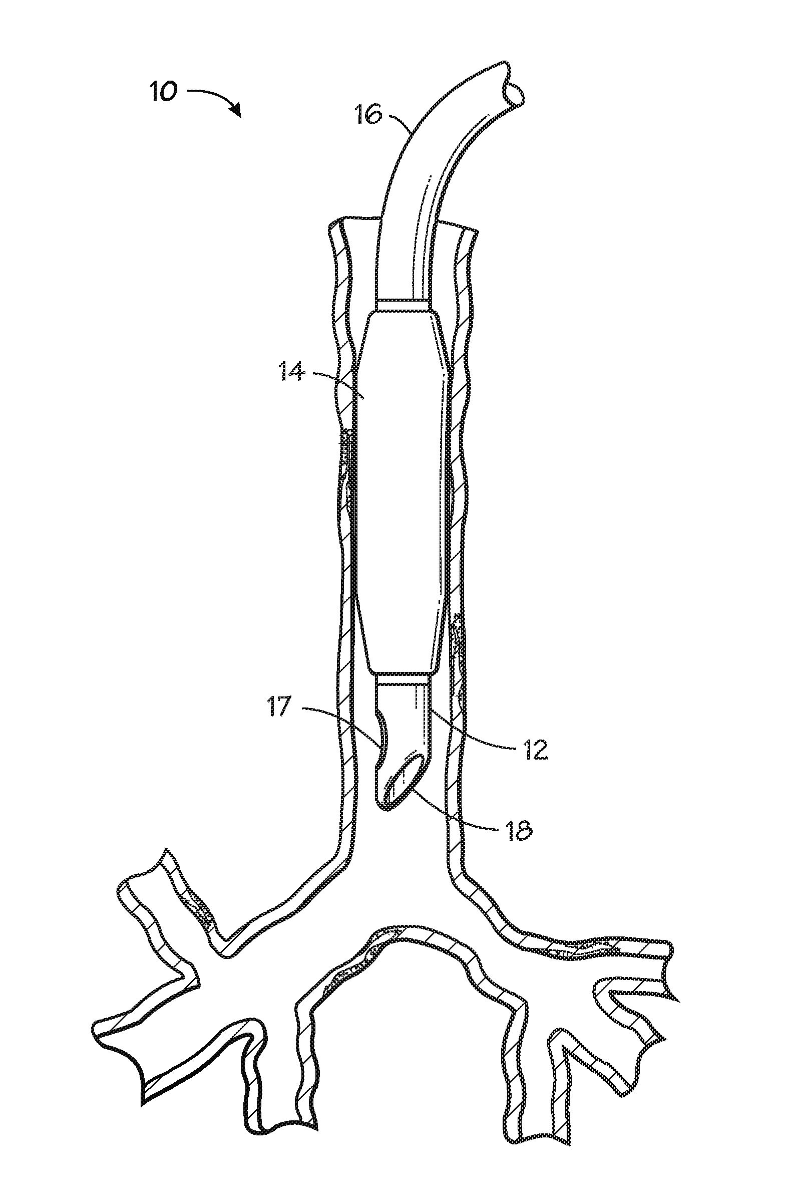 Self-sizing adjustable endotracheal tube