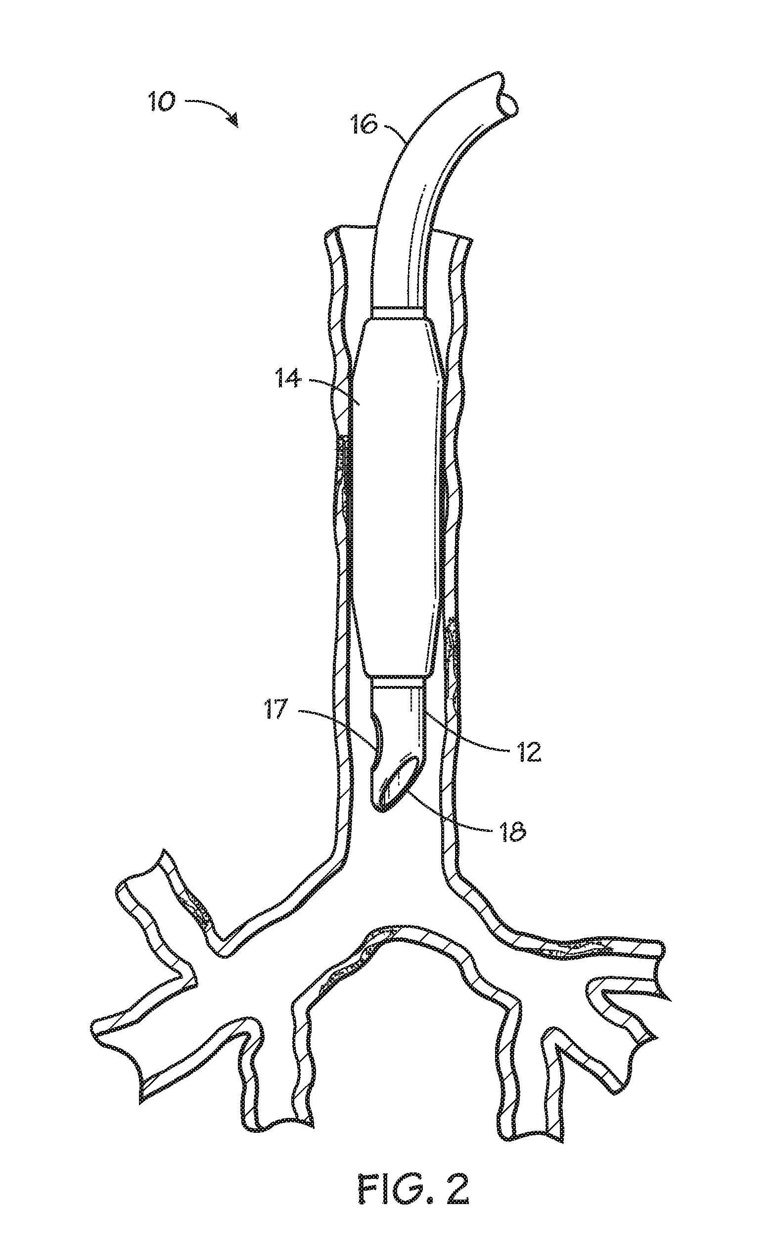 Self-sizing adjustable endotracheal tube