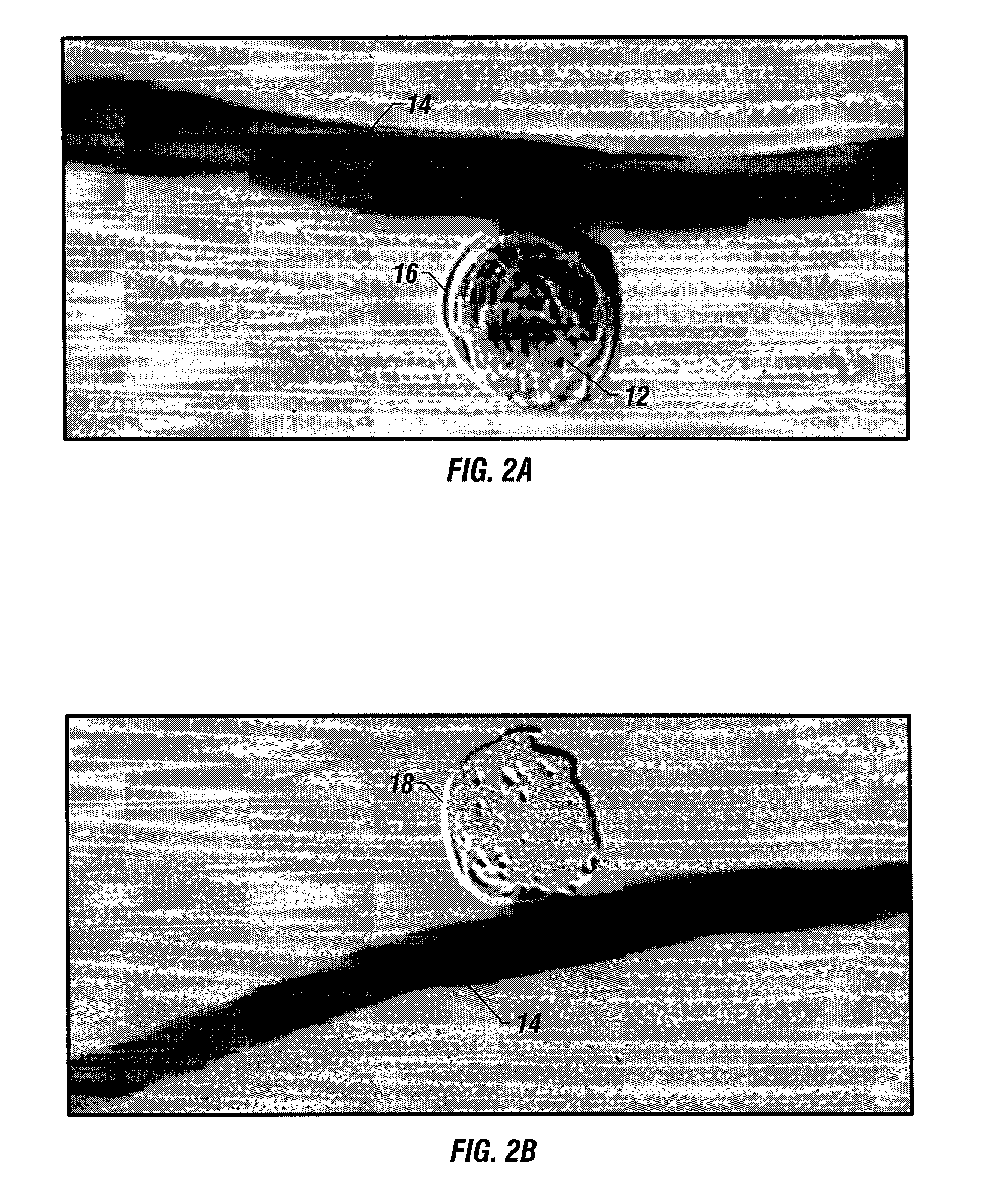 Bioabsorbable polymeric implants and a method of using the same to create occlusions