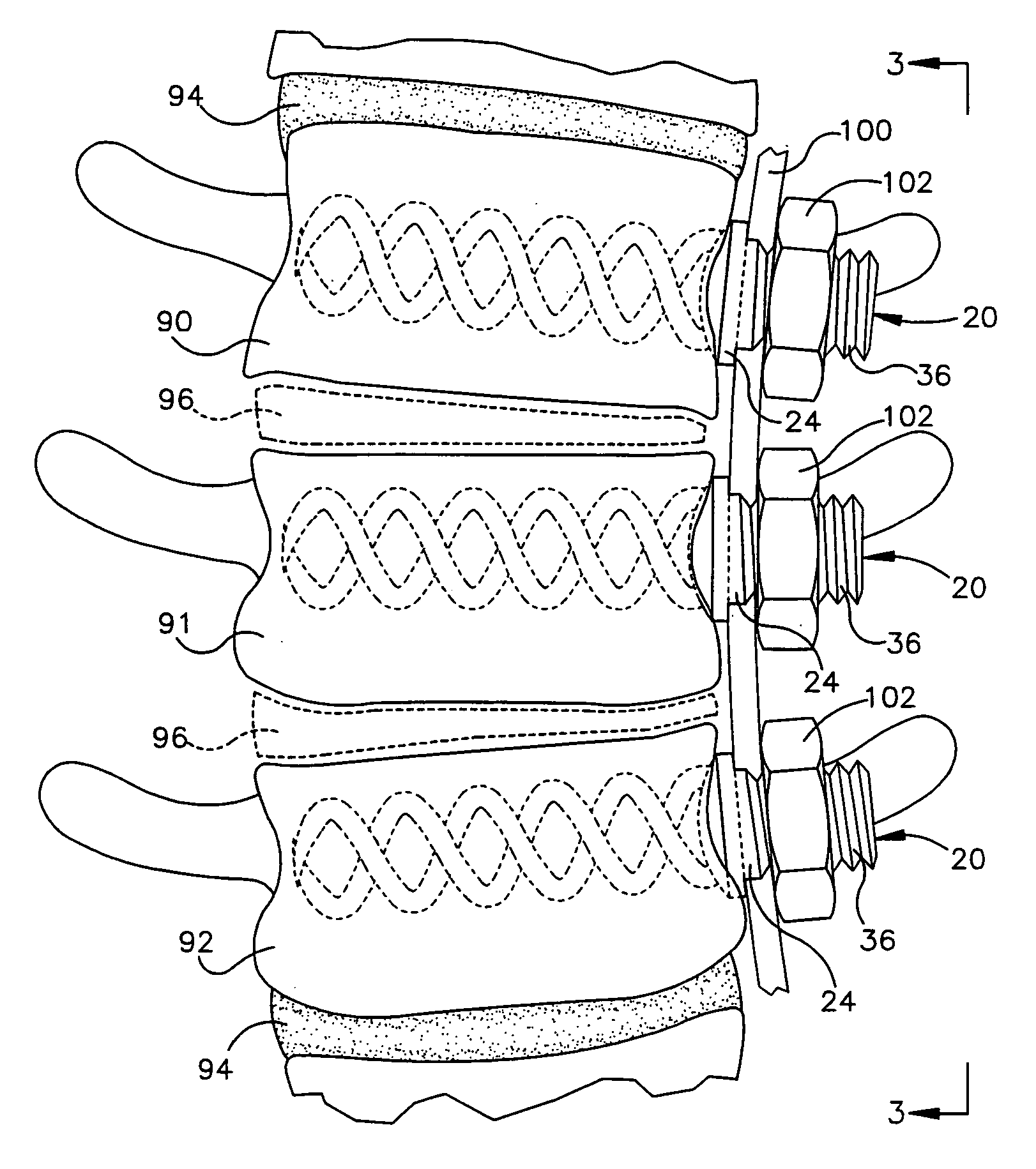 Apparatus for implantation into bone