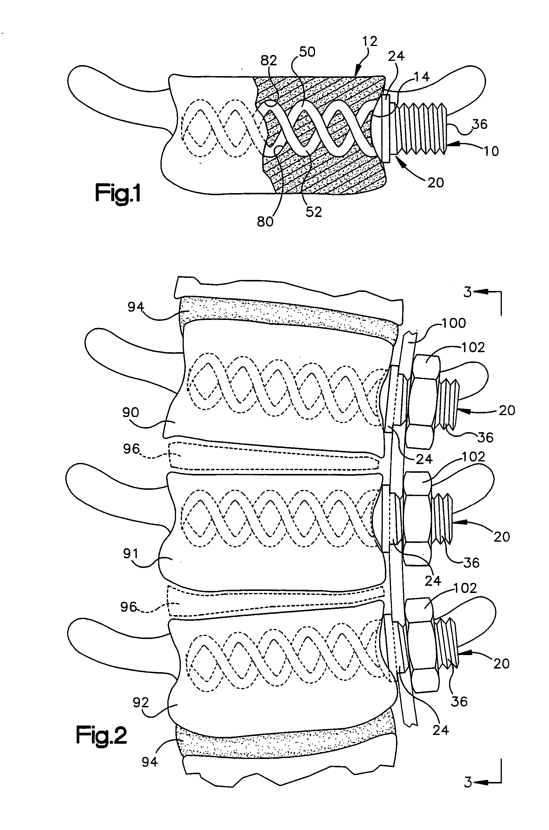 Apparatus for implantation into bone