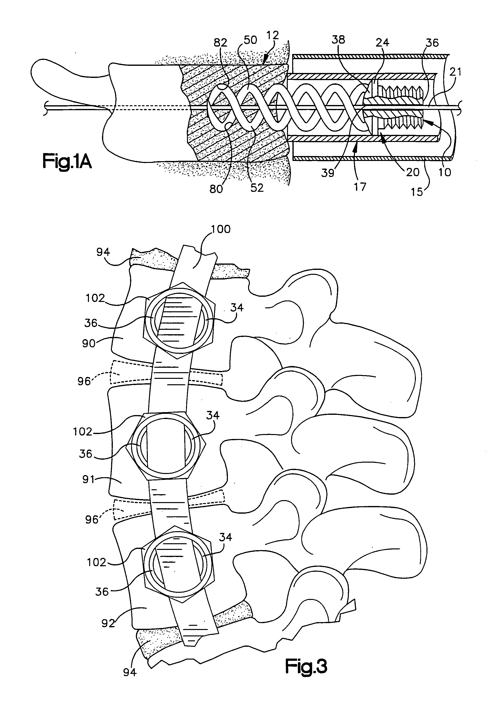 Apparatus for implantation into bone