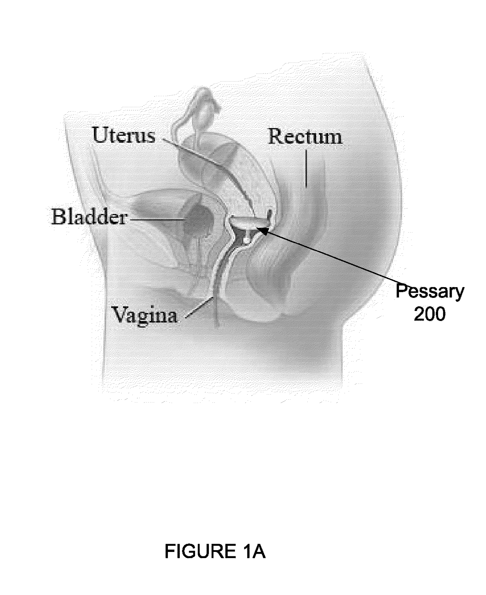 Device and method for fitting a pessary