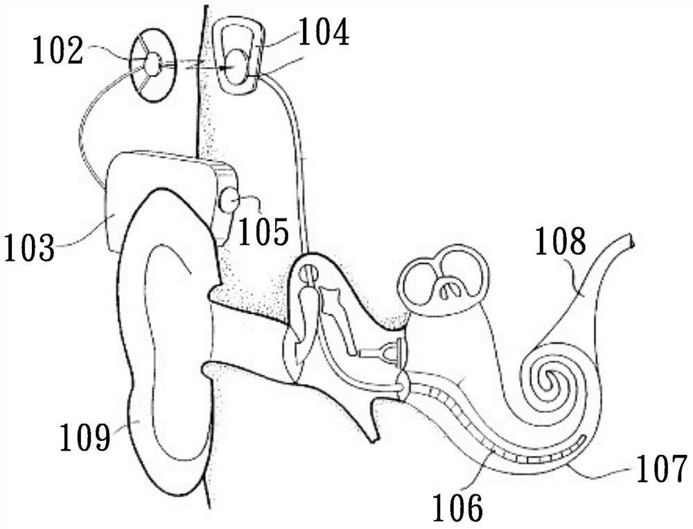 External electronic ear device and artificial ear implant device