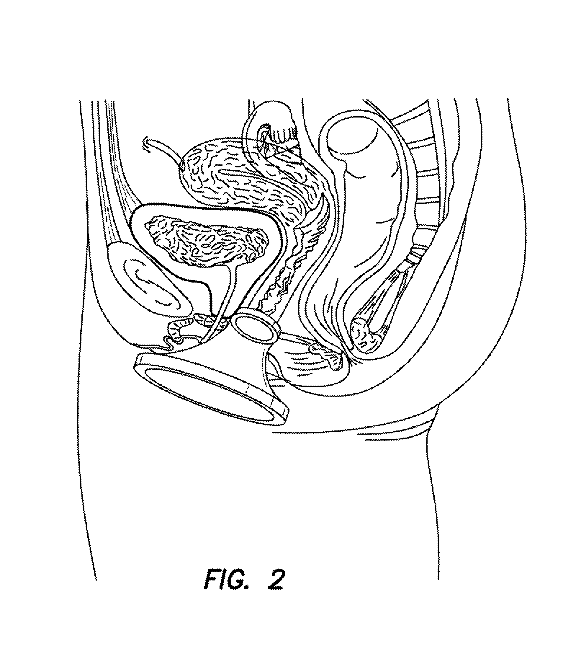 Single port access system