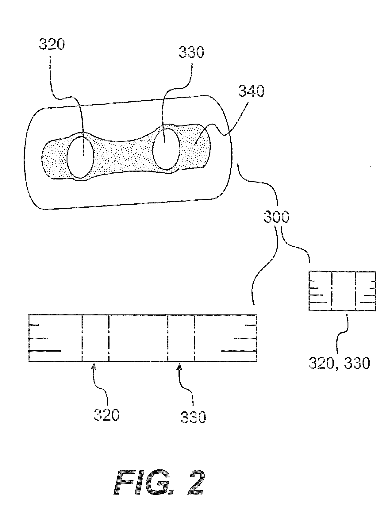 Adjustable Suture Lock Loop