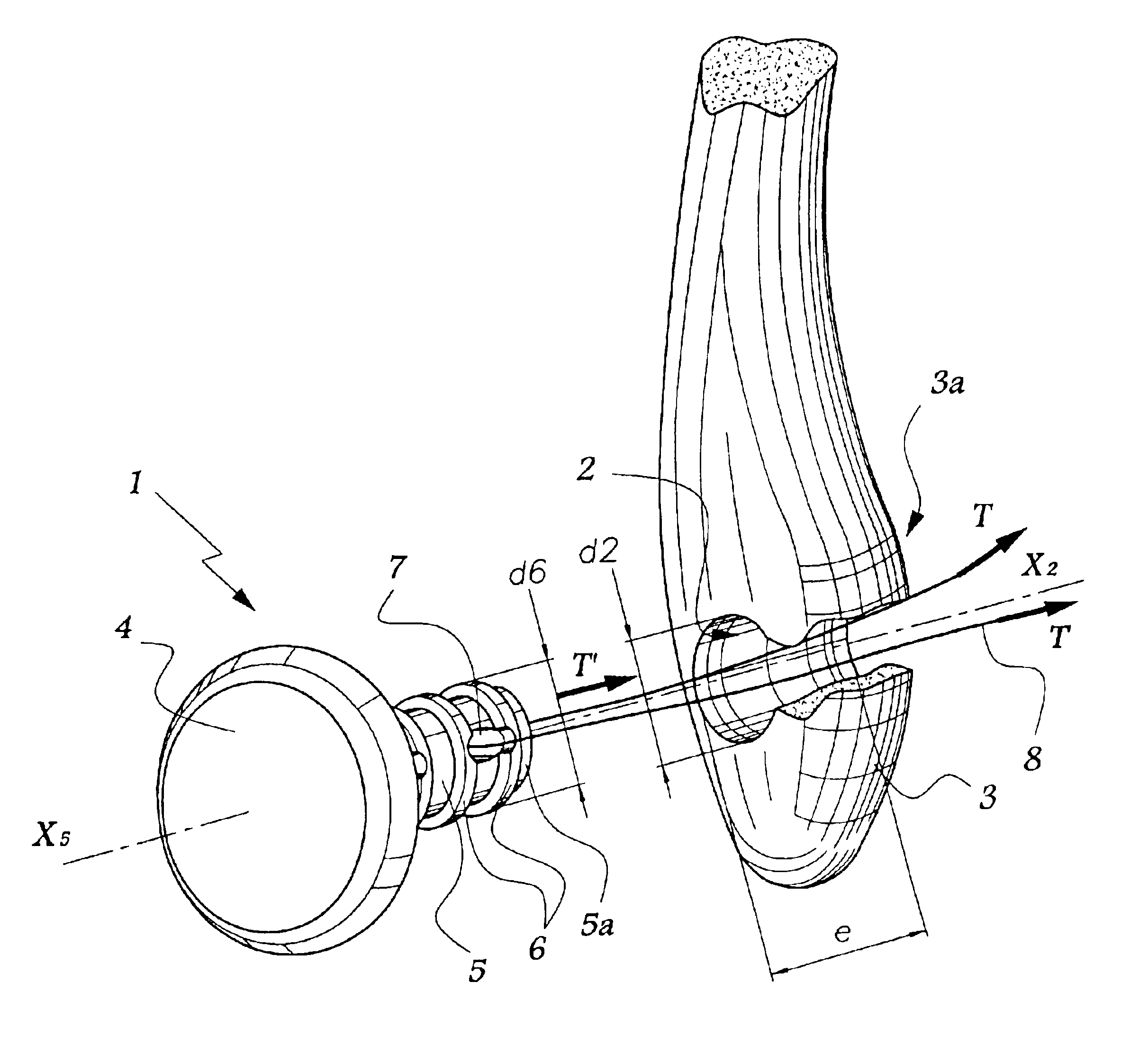 Method of positioning a malleolar implant for partial or total ankle prosthesis