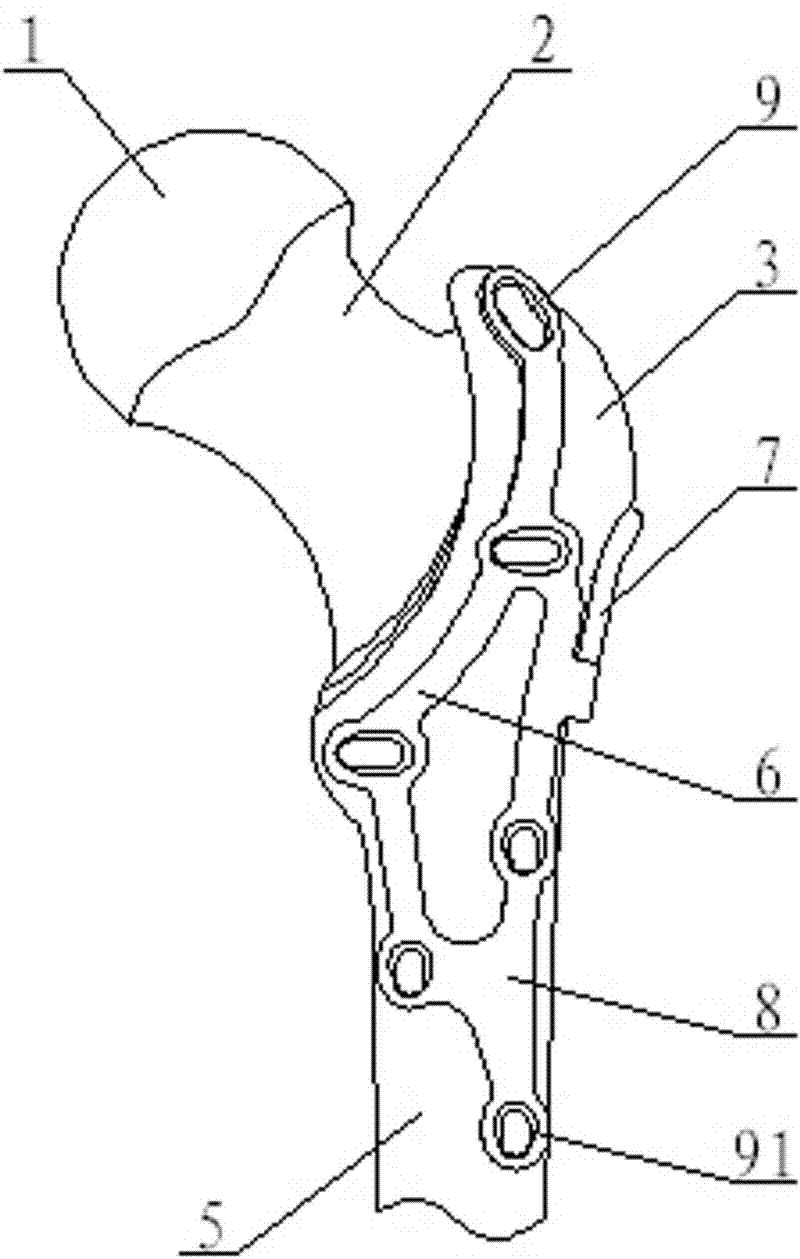 Minimal invasive combined pressurizing and locking bone fracture plate for trochanter comminuted fracture and femoral neck fracture