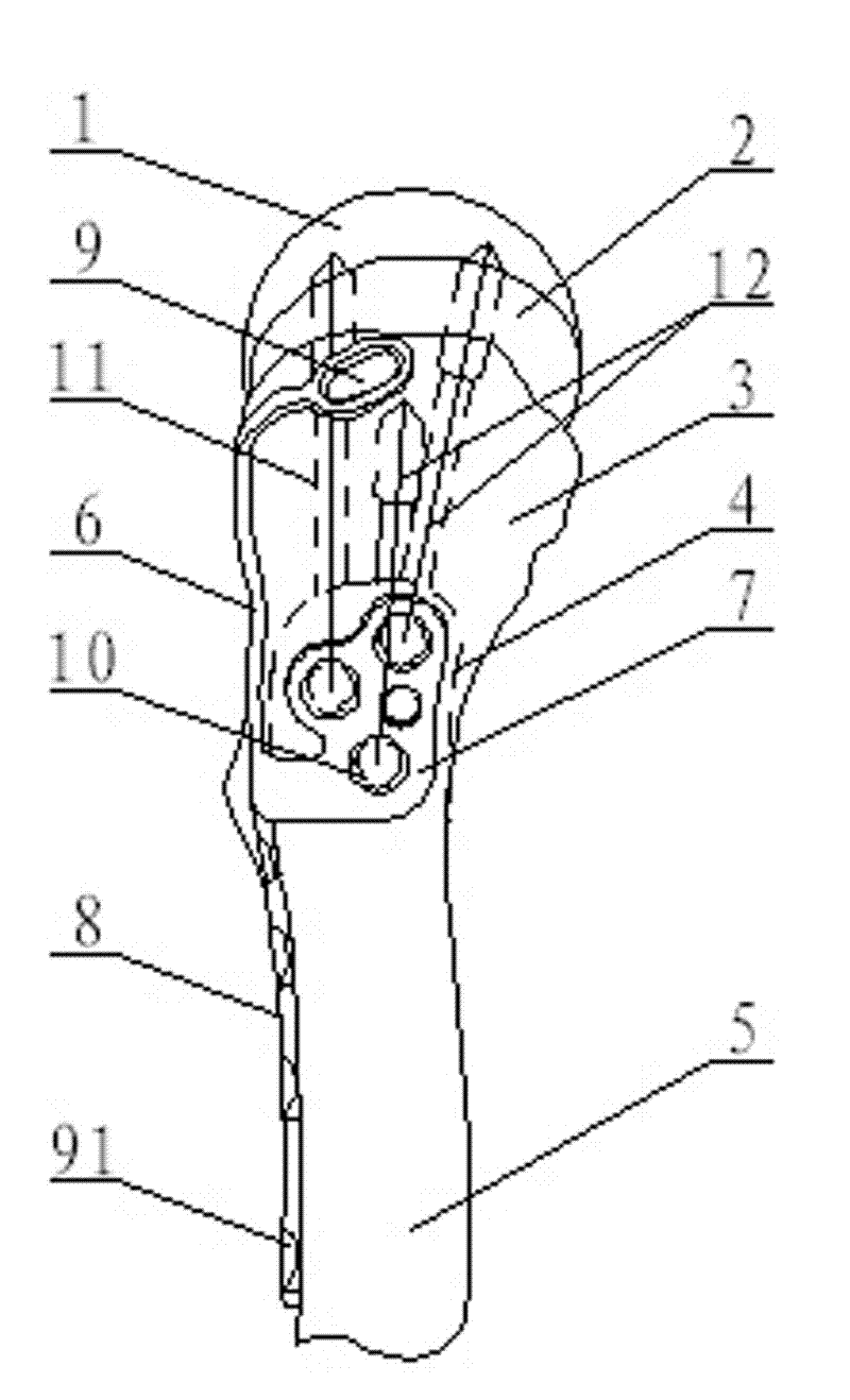 Minimal invasive combined pressurizing and locking bone fracture plate for trochanter comminuted fracture and femoral neck fracture