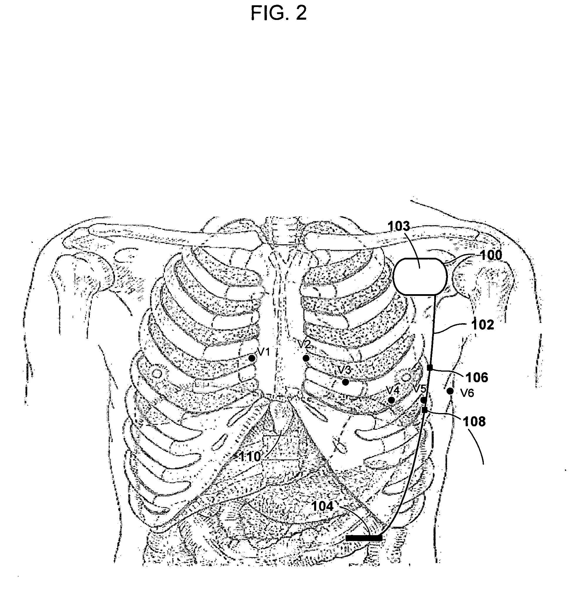 Subcutaneous defibrillation system and method using same