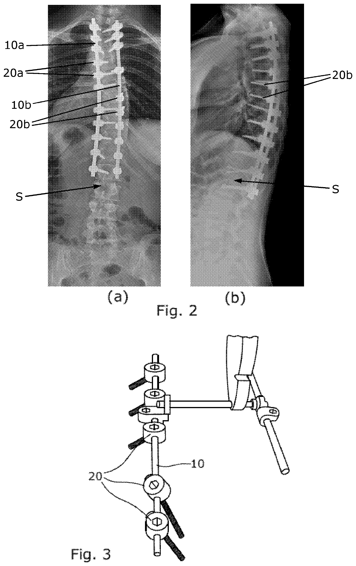 Anchoring device for use in spinal deformity correction surgery