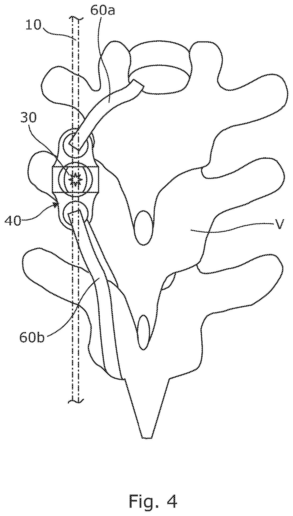 Anchoring device for use in spinal deformity correction surgery