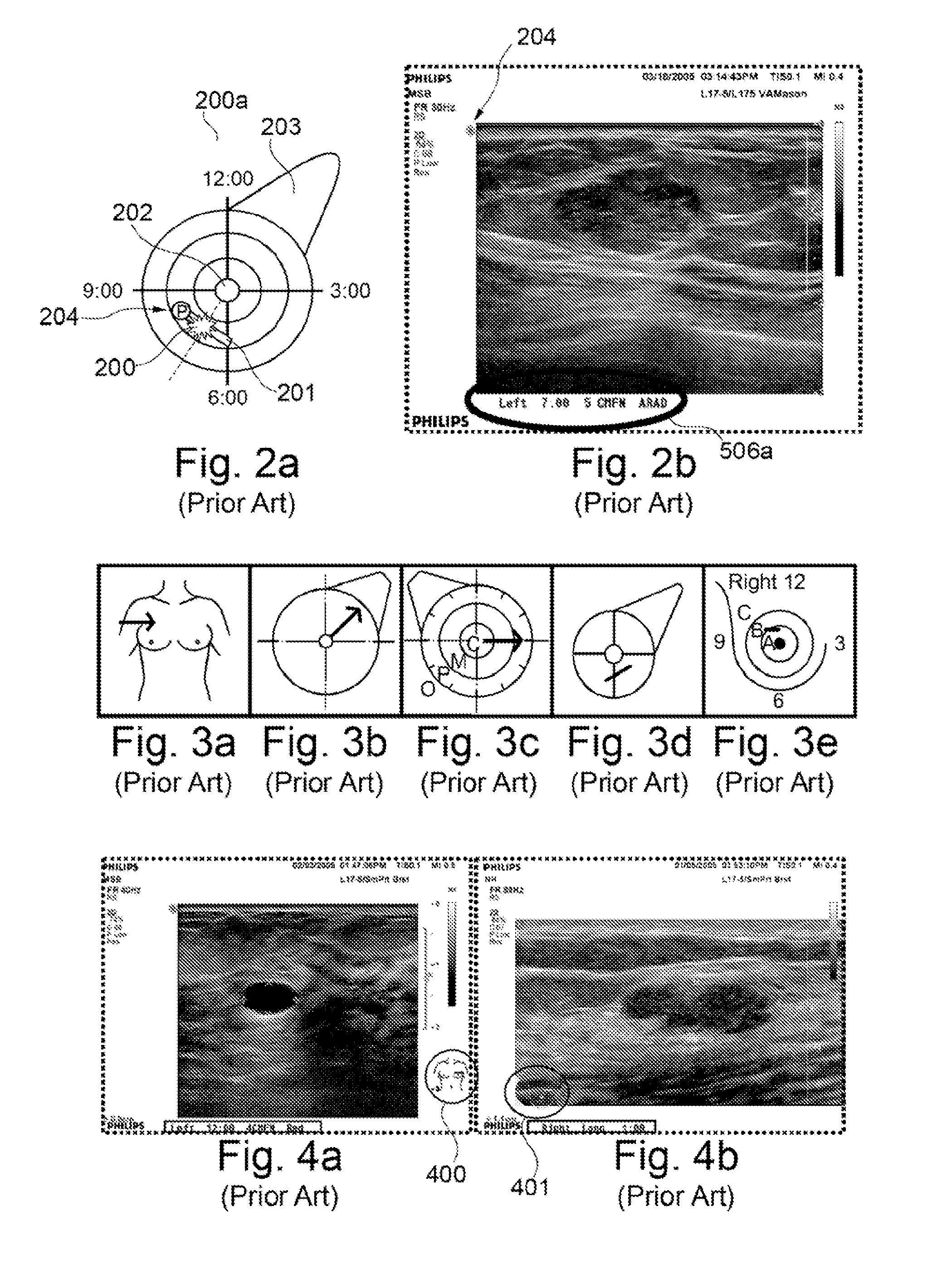 Breast ultrasound annotation user interface