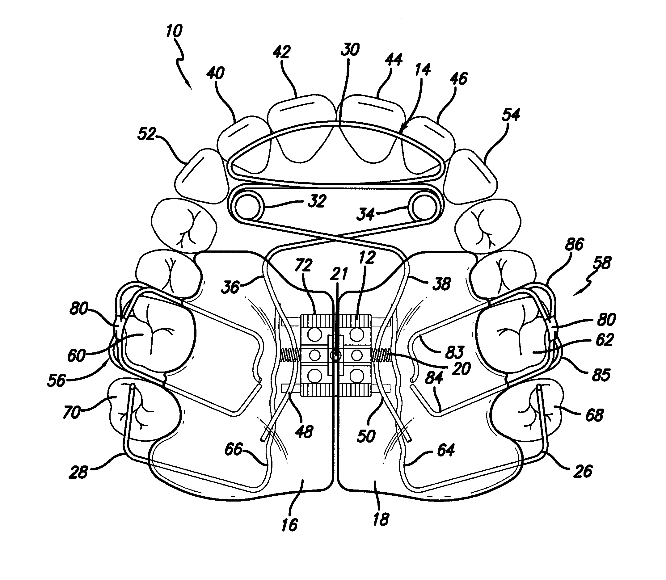 Maxillary expansion and advancement orthodontic applicance