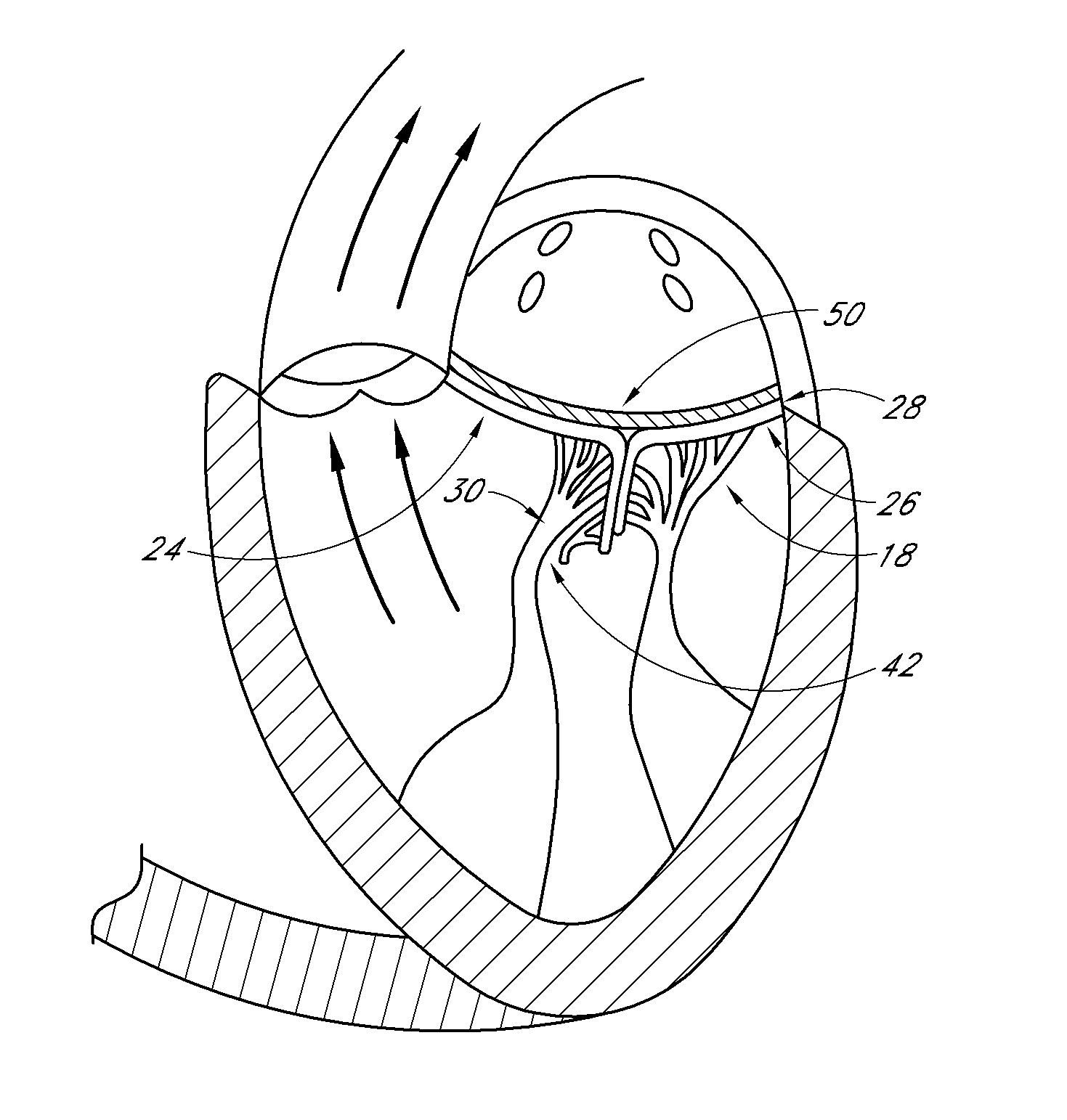 Transvalvular intraannular band for aortic valve repair