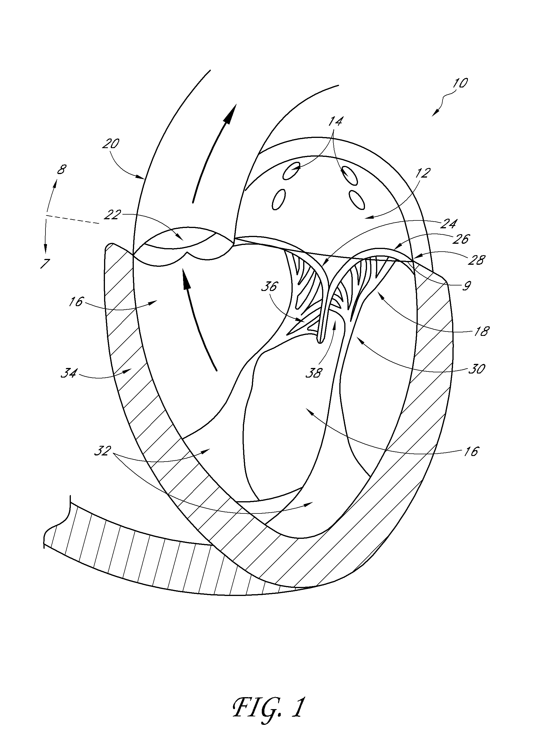 Transvalvular intraannular band for aortic valve repair