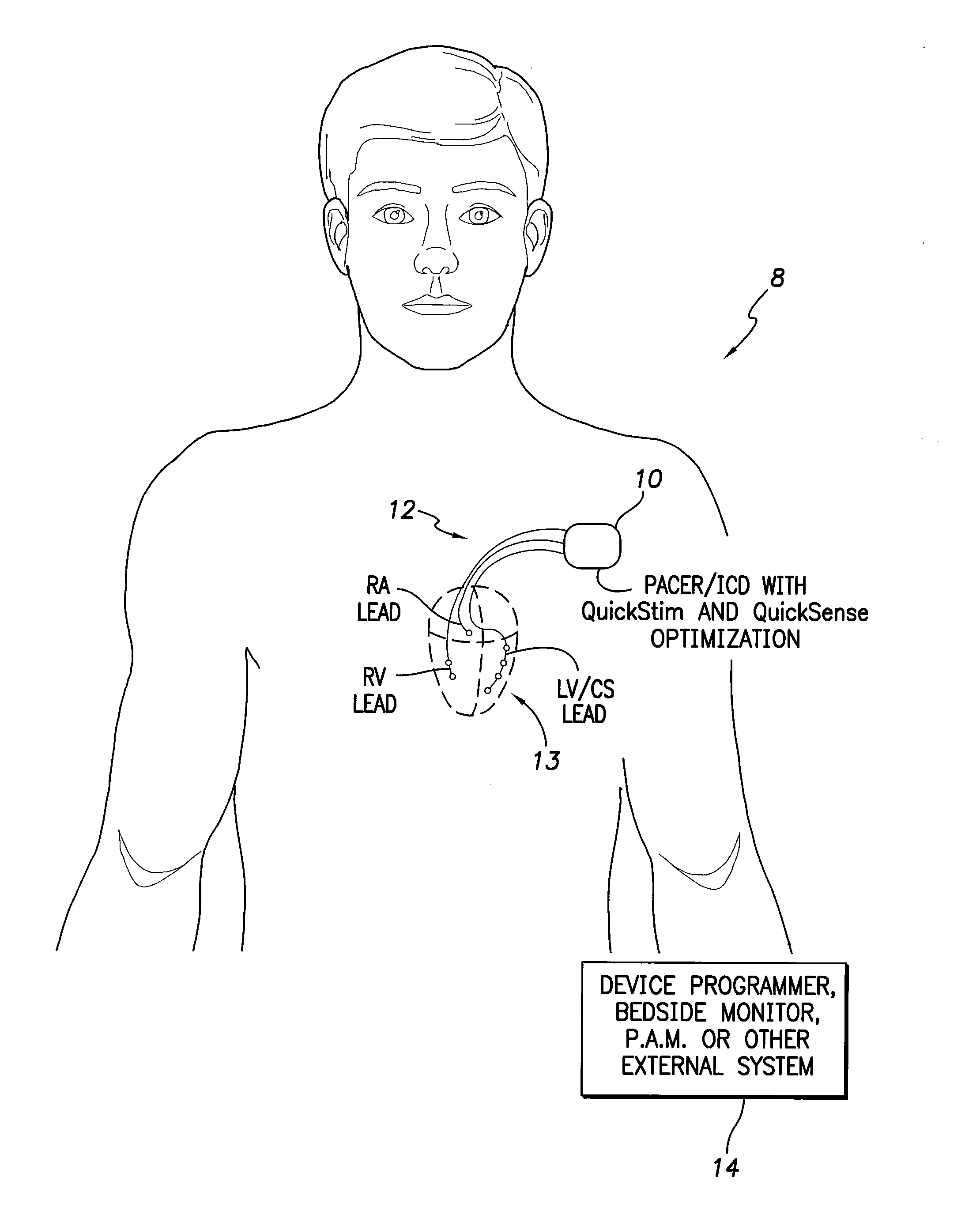 Systems and methods for optimizing multi-site cardiac pacing and sensing configurations for use with an implantable medical device