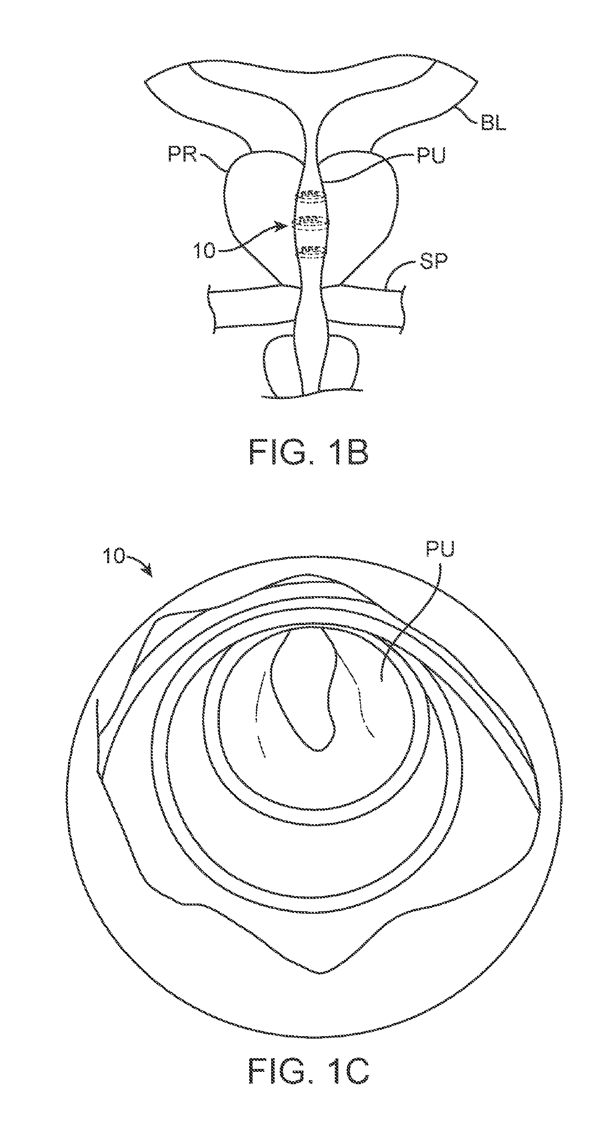 Indwelling body lumen expander