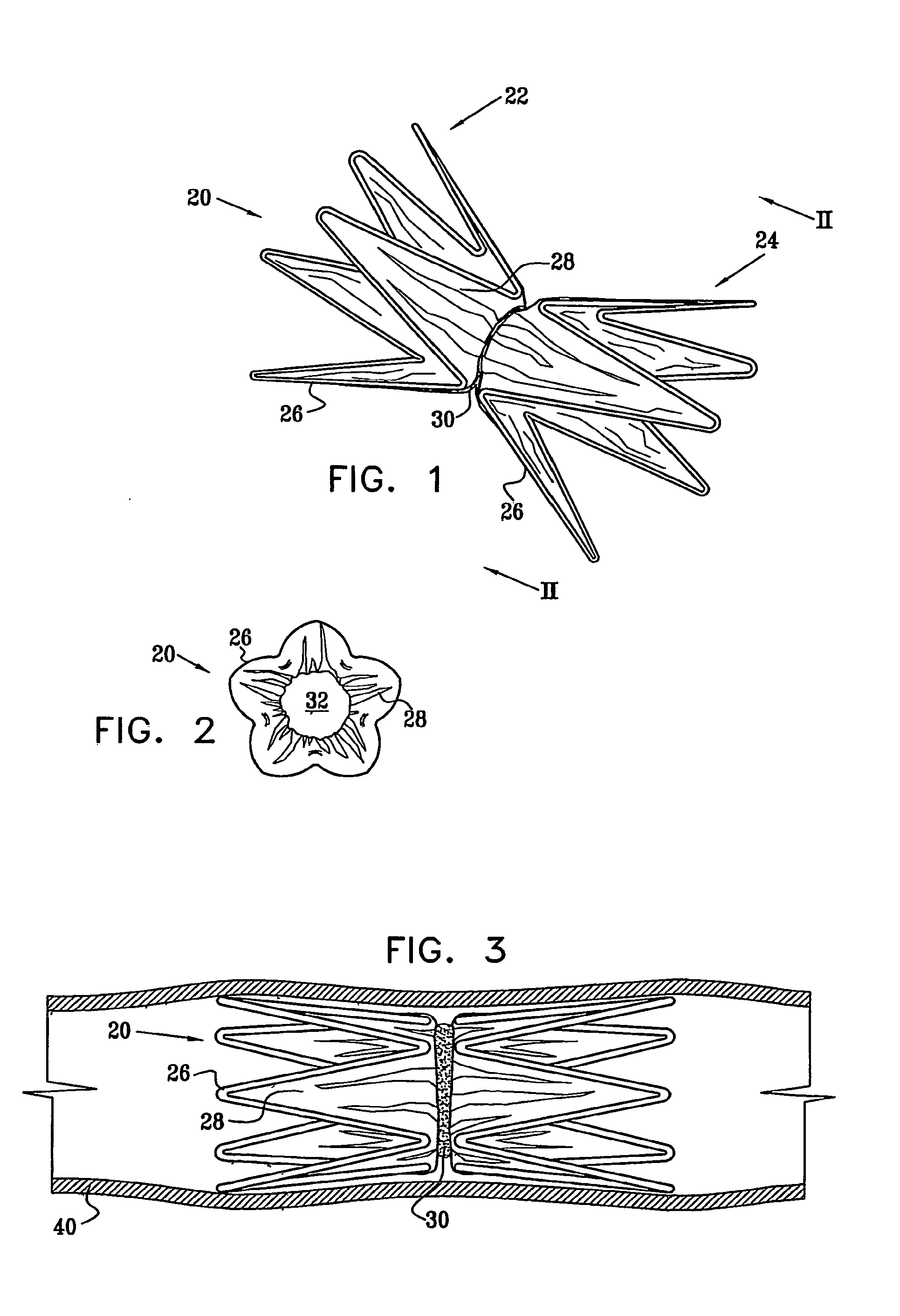 Vascular implant