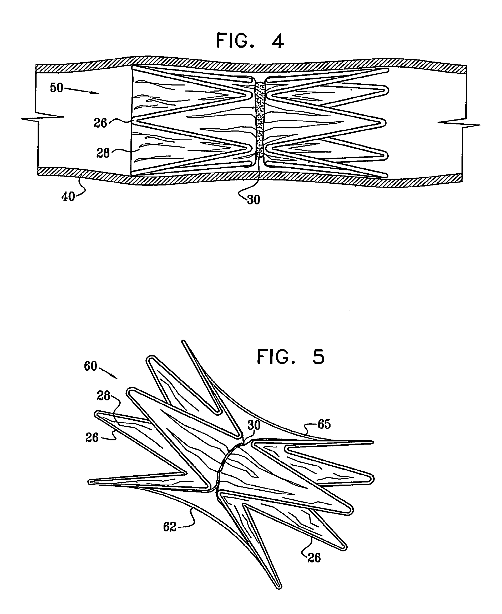 Vascular implant