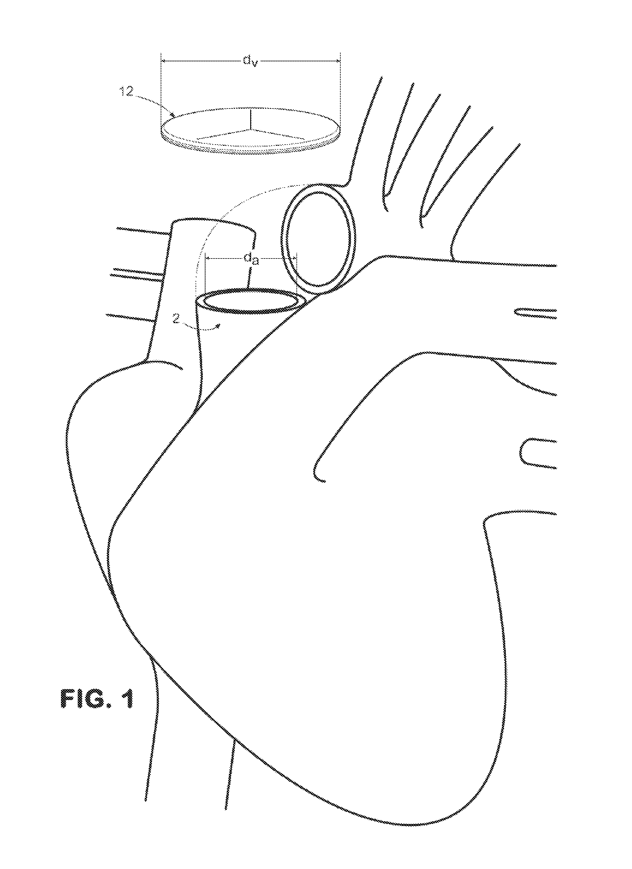 Prosthetic tissue valve