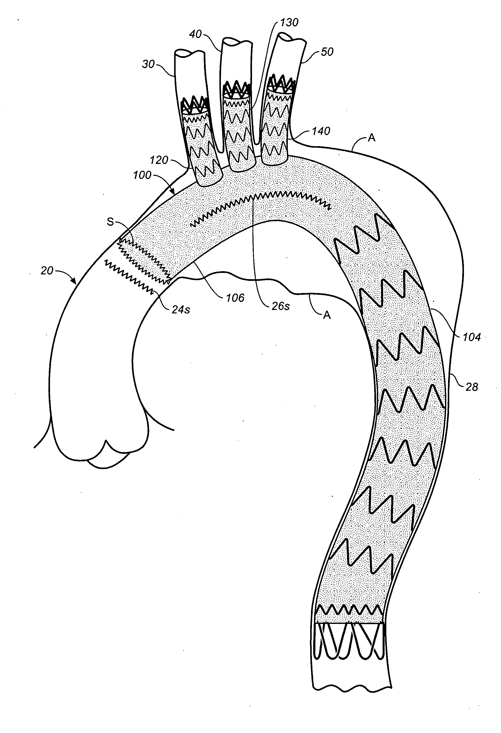 Prosthesis for Antegrade Deployment