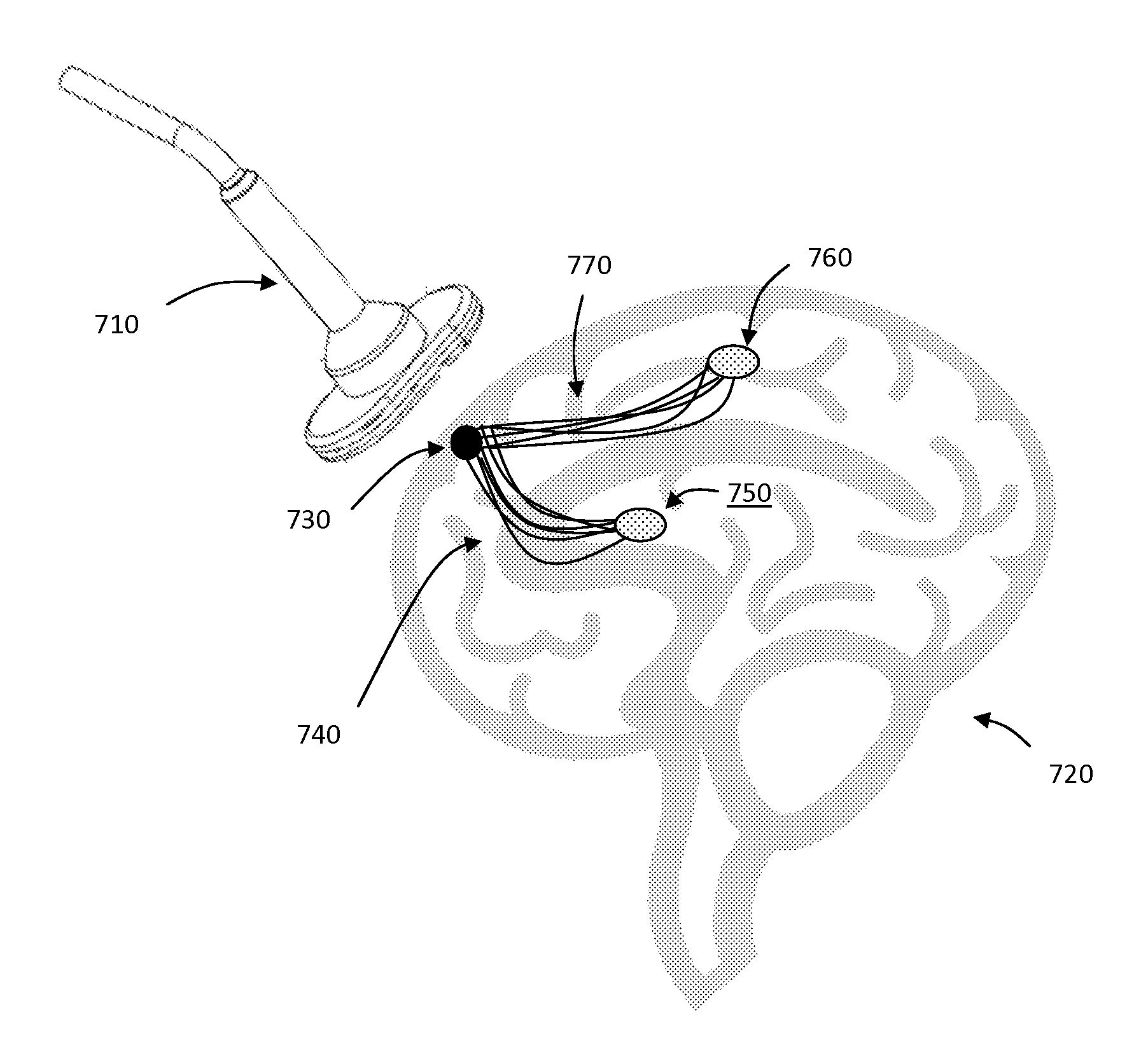 Method and system for combining anatomical connectivity patterns and navigated brain stimulation