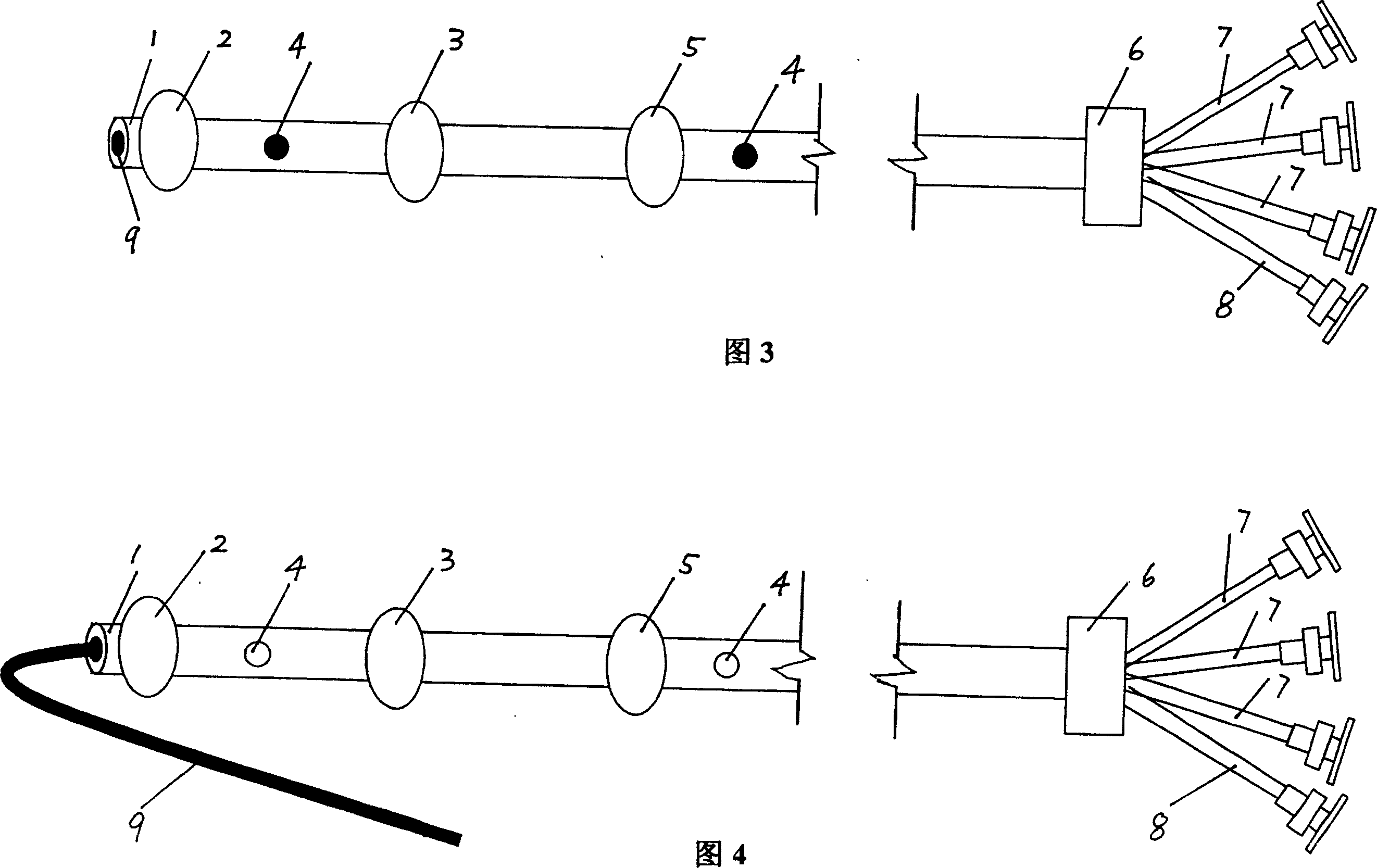 Multi saccule catheter in blood vessel